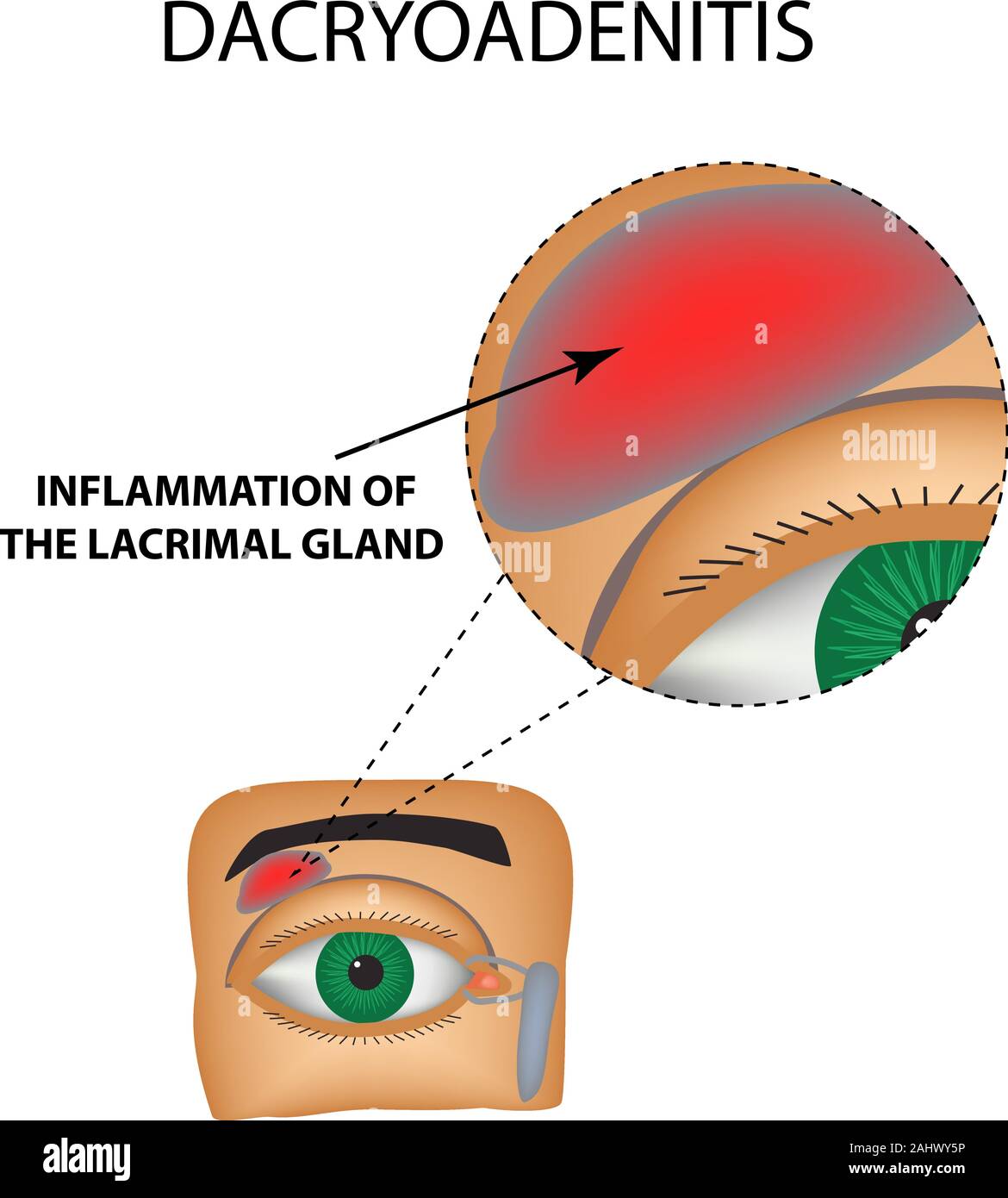 Dacryoadenitis. Entzündung der Tränendrüsen. Die Struktur des Auges. Infografiken. Vector Illustration auf isolierte Hintergrund. Stock Vektor