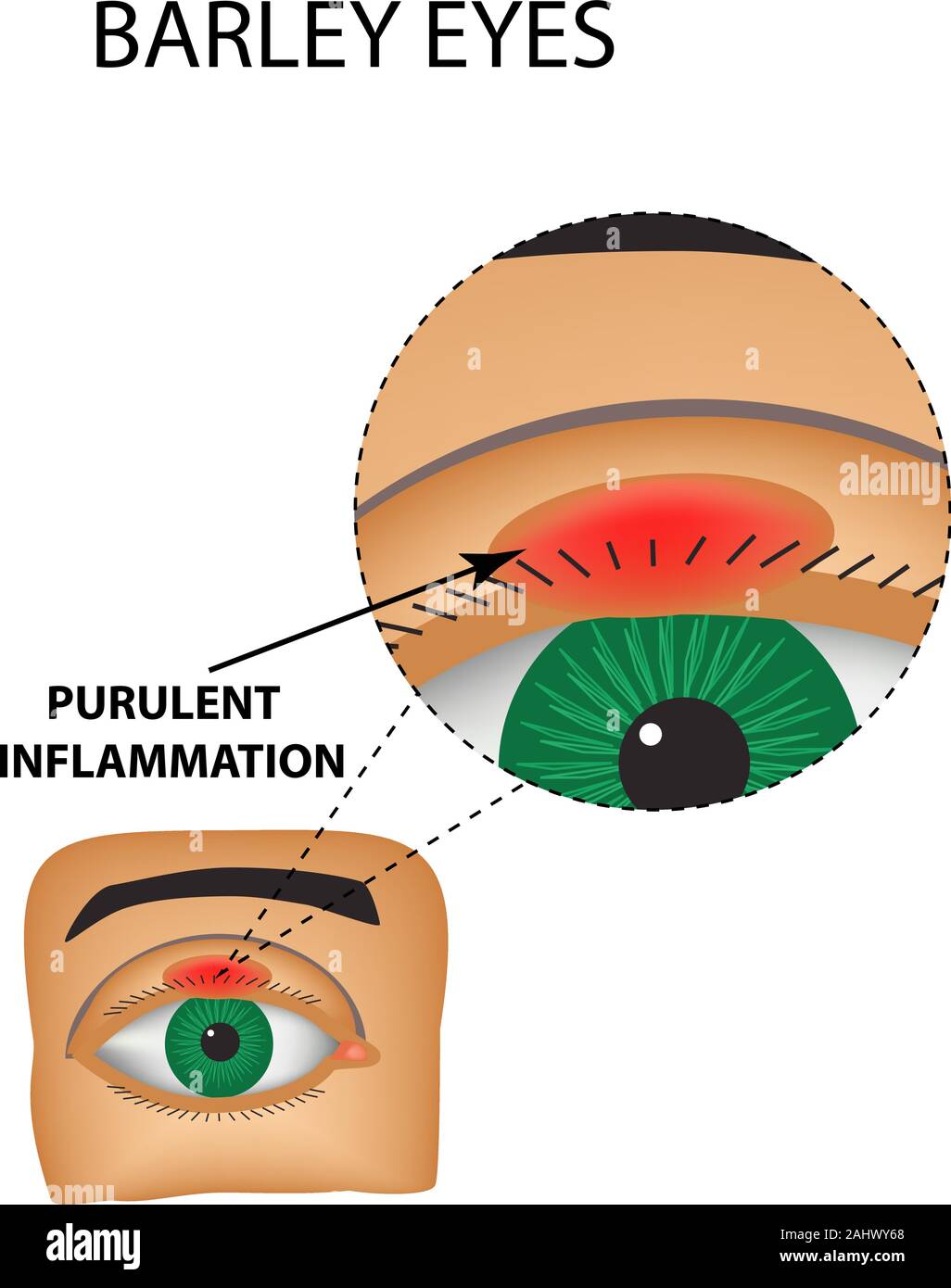Gerste Augen. Eitrige Entzündung. Die Struktur des Auges. Infografiken. Vector Illustration auf isolierte Hintergrund Stock Vektor