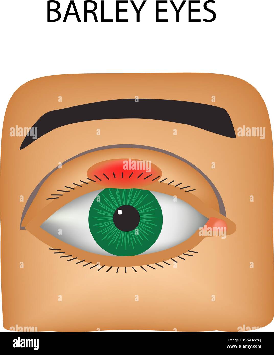 Gerste Augen. Eitrige Entzündung. Die Struktur des Auges. Infografiken. Vector Illustration auf isolierte Hintergrund Stock Vektor