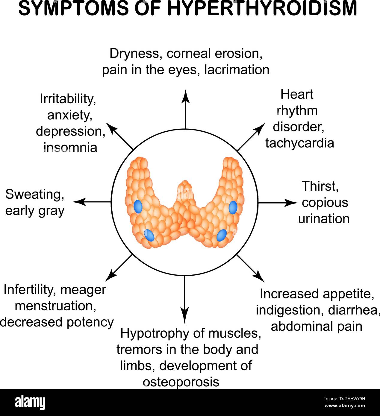 Symptome einer Hyperthyreose. Schilddrüse. Infografiken. Vector Illustration auf isolierte Hintergrund. Stock Vektor