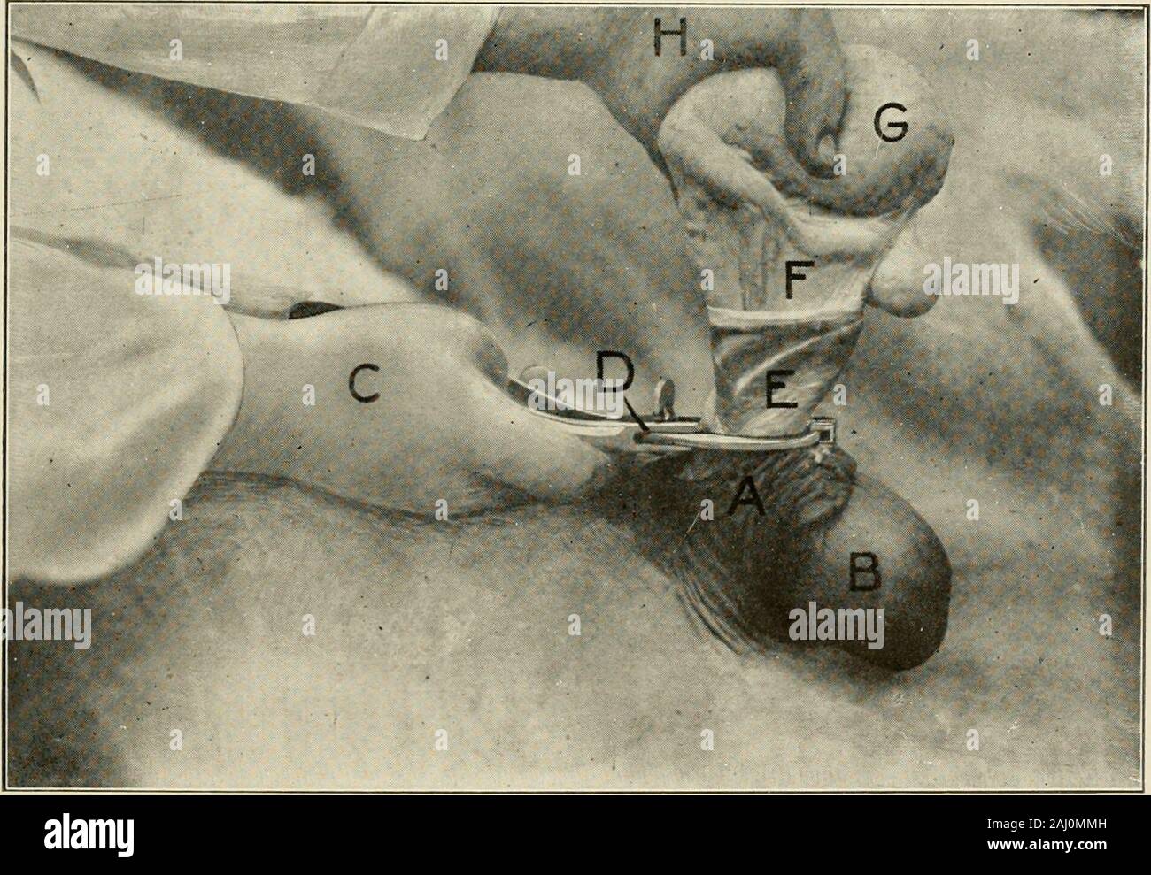 Tier Kastration: ein Buch für Studenten und Praktiker. Abb. 29 - Kastrieren tlie Maultier. T, Linke Hand: U, Hoden; V, Samenstrang; W, Tunica vaginalis: X, Hodensack; Y, Rechts: Z, Emasculator.. Abb. 30 - die ordnungsgemäße Position der Emasculator und Verhältnis von Hoden, SpermaticCord, Tunica vaginalis und Hodensack in Maultier Kastration. 46 Axi^^ iAL (asthation von maultier Kastration, nämlich: hydrocele (^ Vater Tasche), eine conditioninvariably produziert von Durchtrennen Sie das Kabel unten - mit Maultier instanding Körperhaltung - die Tunica vaginalis. Natürlich ist der oppositetesticle ist in der Art und Weise, wie und das Tier r entfernt Stockfoto