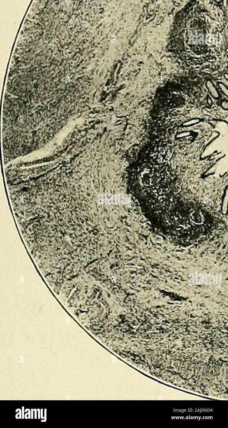 Blinddarmentzündung: seine Pathologie und Chirurgie. Er Fasern getrennt durch inflammatoryexudation. Die submukosa enthält eine moderate Menge matory inflam-Zellen, und die Blutgefäße und. Lymphatics sind geweitet. Die muscularis mucosae ist wahrscheinlich nicht vorhanden. Die lymphoidfollicles Form fast eine komplette Ring; so viele wie neun können in einem Abschnitt becounted. Sechs werden von der Lumen durch 1 Huntericm Vorträge über traumatische Infektion, Edinburgh und London, 1896, S. 1). 71, ct ff., Abb. 15, 16, und 17. Ein NIEDLICHES SCPPUA-A gewann 1 S 3 tubuläre Drüsen; drei Projekt so weit das Lumen des theappendix, in die wegen Stockfoto