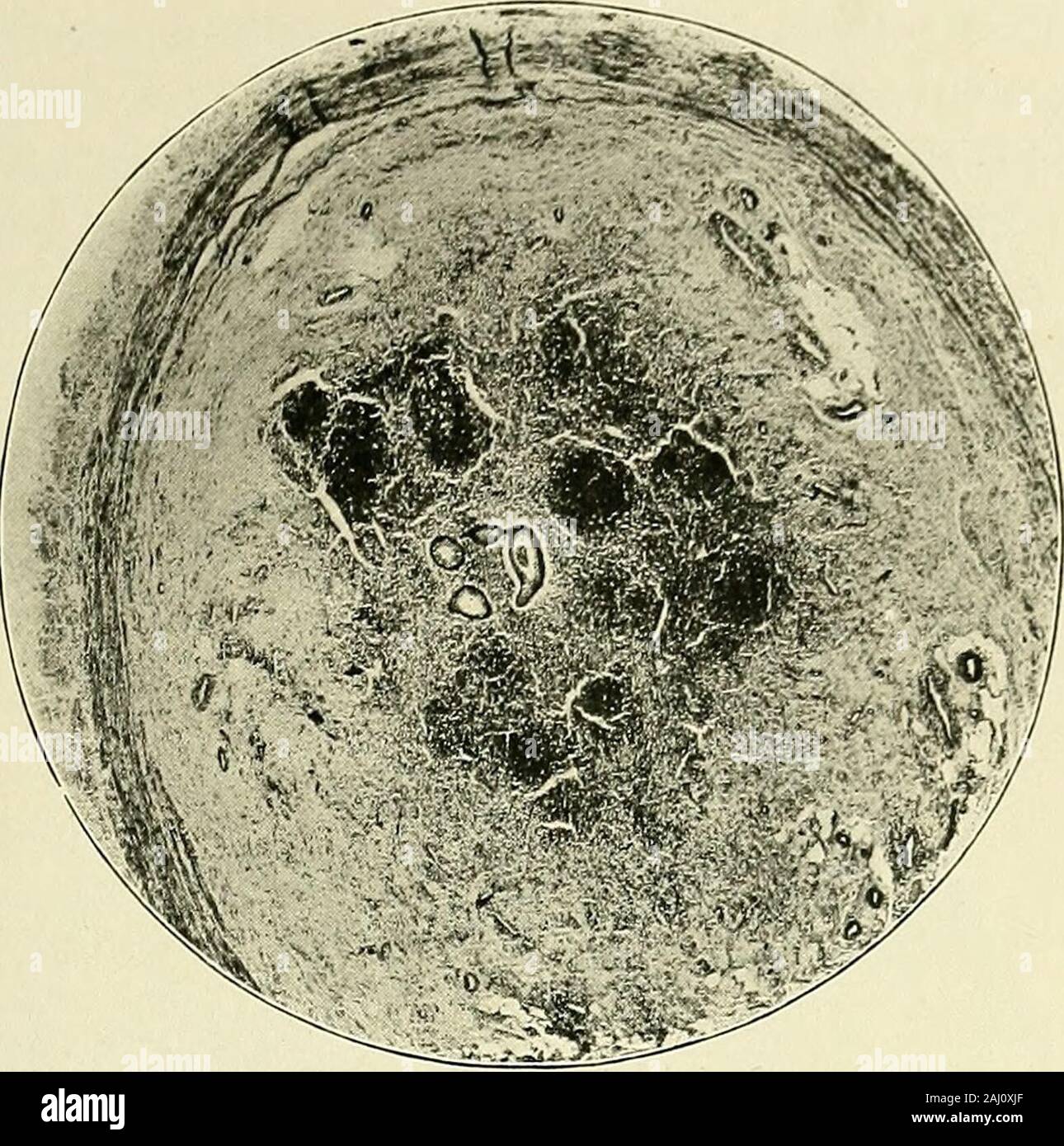 Iliac Stenosis Stockfotos und bilder Kaufen Alamy