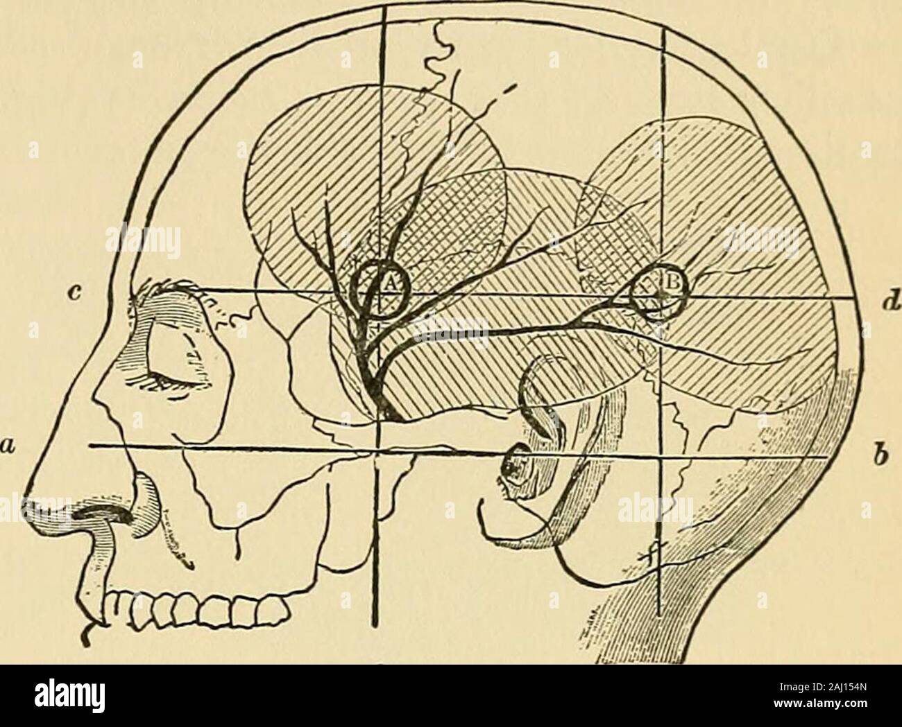 Operative Chirurgie. Operationen auf das Nervensystem. 237. Trephining im Laufe der wichtigsten Schiffe sollten vermieden werden, ex-Cept aus besonderen Gründen. Die mittleren Hirnhaut Arterie und seine Äste und die zerebrale Nebenhöhlen sind von besonderer Bedeutung in diesem Zusammenhang. Die mittleren Hirnhaut Arterie. - Nach der Eingabe des Schädels die middlemeningeal teilt sich in zwei Zweige, Anterior und Posterior. Der ante-rior Filiale läuft in acanal oder Nut auf der Oberfläche des Steuergehäuses einen-tero unterlegen Winkel von theparietal Knochen (Abbn. 273 und 275), Nach oben und etwas nach hinten zu thesagittal Naht bingabout Drei qu Stockfoto