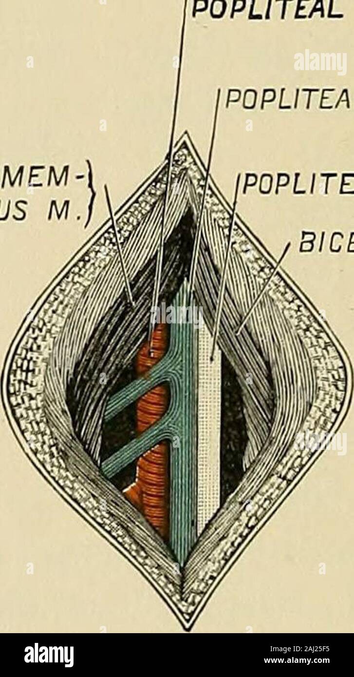 Operative Chirurgie. starb. Eine ältere Serie zeigt Folgendes: Die commonfemoral hat ligatured wurde 31 Mal für Apoplexie, mit einer Sterblichkeit von 40 Prozent, Blutung occurringin 60 Prozent der Fälle. Beenligatured Thesuperficial femoral hat 204 mal, mit amortality von 50 Fällen. Ligatur der Tiefen FEM-mündlichen Arterie (die Profunda) und der externen Zirkumflex. - Die Relation, die die Pro-forating Zweige Dieser vesselbear zu den Oberschenkelknochen und deren Lia-bilität der Verletzung in Fraktur ist ofmuch Bedeutung. Die authorhas einen Todesfall fromsecondary hsemorrhage followrupture des dritten Perf gesehen Stockfoto