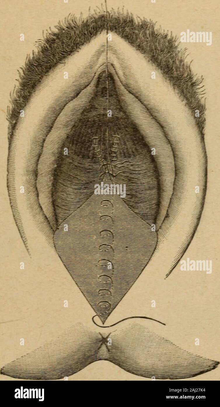 Patologia e terapia delle malattie delle Donne ad uso dei Medici pratici. ivamente un Punto profondo Sotto tutta La ferita, eduno più superficiale; ich Fili si annodano Subito, e si fa Colla massima Ra-pidità La chiusura della Parte cruentata. Quanto più Questa va Diminuendo, Tanto meno necessario Diventa iltenderla Colle pinze uncinate, che vengono perciò tolte cominciando dallelaterali. Se Non si riesce eine stringere un Punto profondo In Modo di por-Tara ich margini ein mutuo Kontakt, e si vedono ich tessuti tendersi in modocompromettente per la Guarigione, si seguirà il Consiglio di Hegar, PÒ-II. Stockfoto