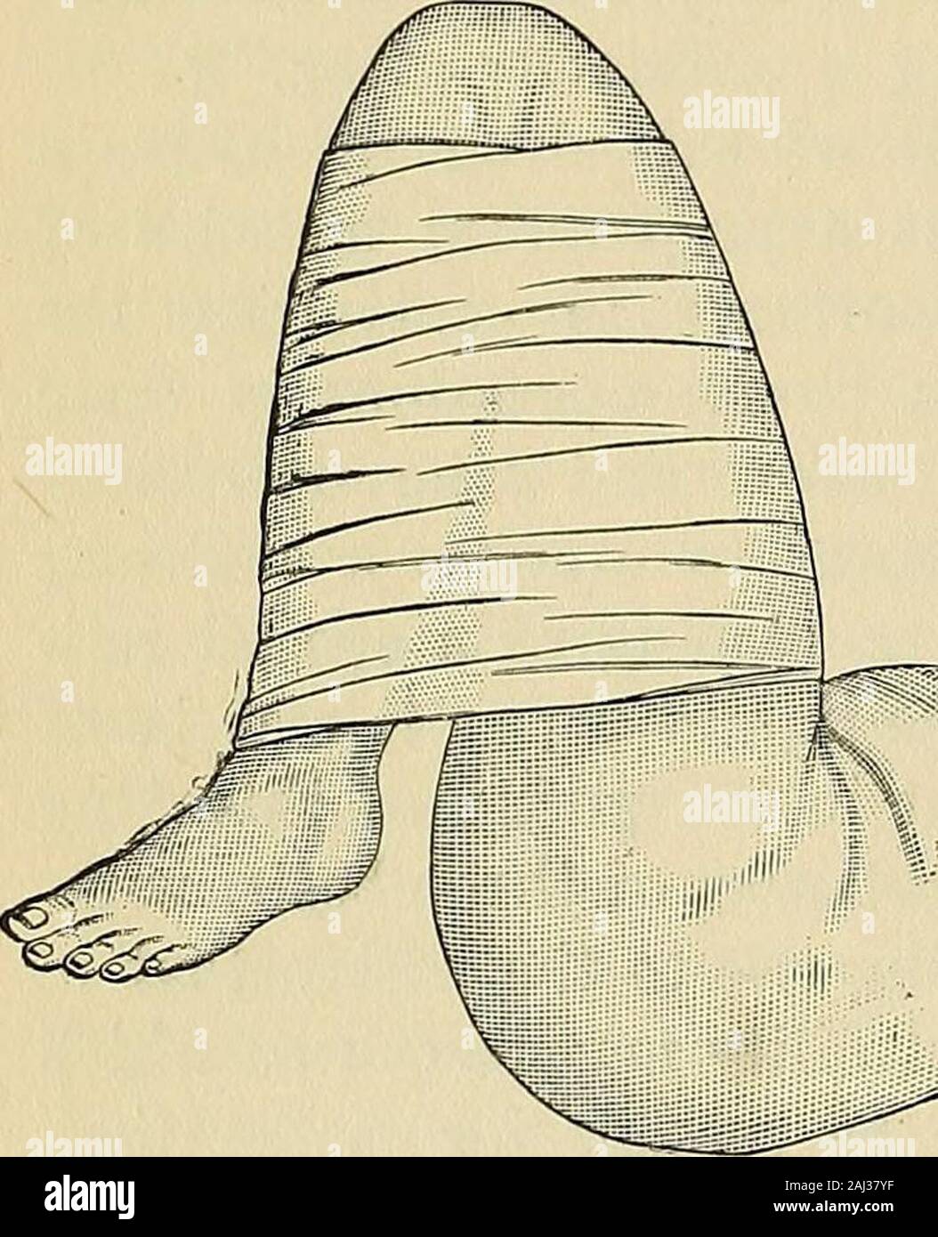 Operative Chirurgie. Evolution ist besser, vielleicht, als theplain Collodium./, die Position. - die Höhe oder den Flex-ion der Gliedmaße (Abb. 74) behindert die Circus-* tPtt:::^W,: "espcclally ktlou, die weiter entfernten Teile des Körpers, und somit Ausschuss entsprechend vermindert den Grad der haemor - rhage dieser Teile. Die Rückseite der thisEiG. 74 - Beugung des Knies Prinzip gezwungen Räte die Absenkung des headfor vorübergehende Festnahme von hsemor - •^, ich, •, t i-, r n i rhage in der kniebeuge Platz. Der Patient aus dem Verlust von Blut niedergeworfen werden. Die Bandagen - Bandagen ca Stockfoto