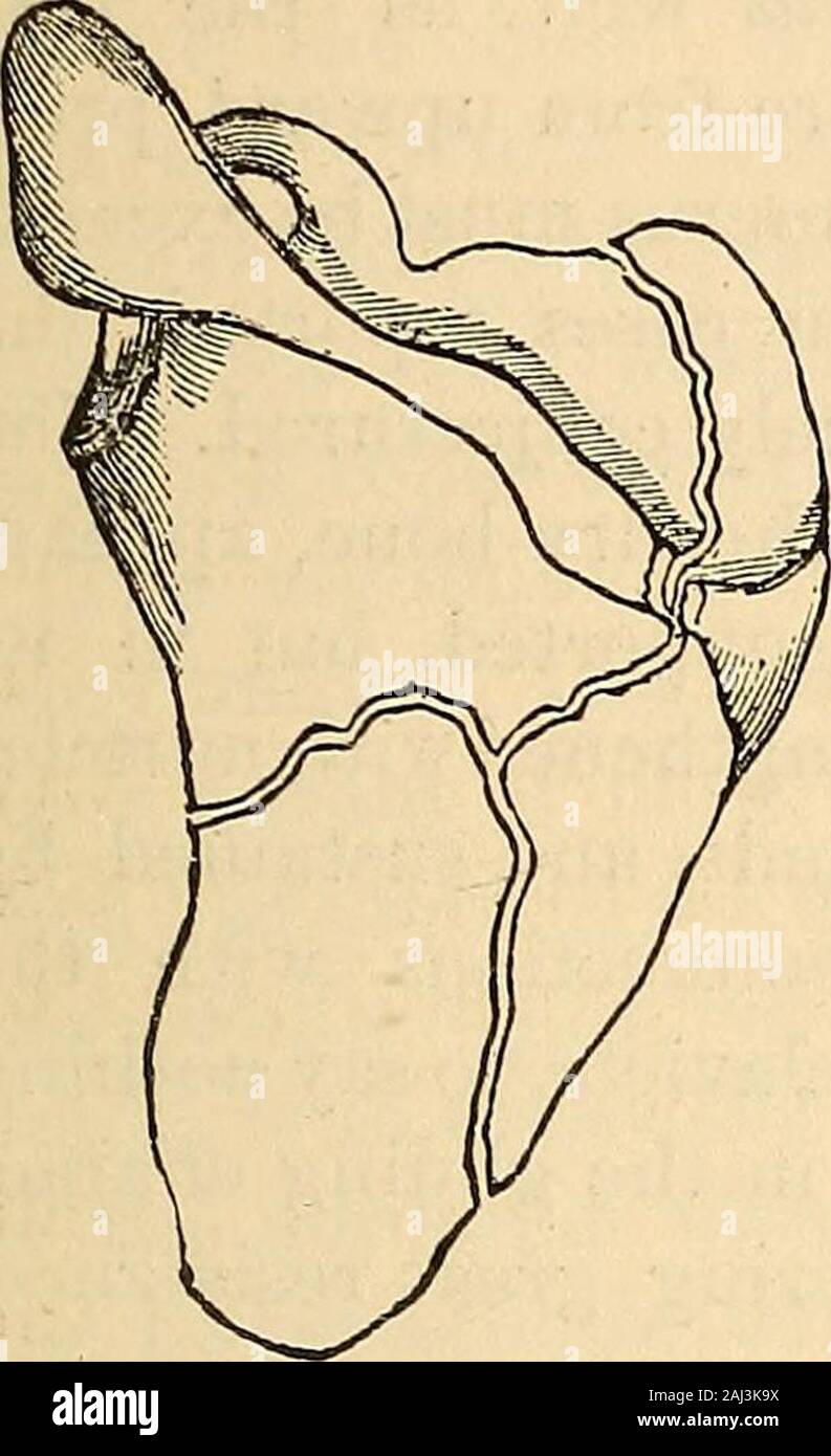 Eine praktische und systematische Abhandlung über die Brüche und Verwerfungen. g den Arm als Hebel, um die Bewegungen zu schüren. Occasionallythe Körper des Schulterblattes ist in mehrere Stücke zerbrochen. Ln diesen Fällen ist es unmöglich, genau -, Trace die Umrisse der Fragmente, oder die Fragmente inplace zu behalten, indem jede Art von einem ankleidezimmer Ly. Behandlung von Frakturen über den Körper der Scapula. - Thefragments in ascompletely reduziert wie möglich von manipula- tion, ein breites Verband oder Streifen von Ad-hesive appliedaround Gips sollte der Arm, Brust und Schulter, (einschließlich Der schulterblatt), um es zu halten Stockfoto