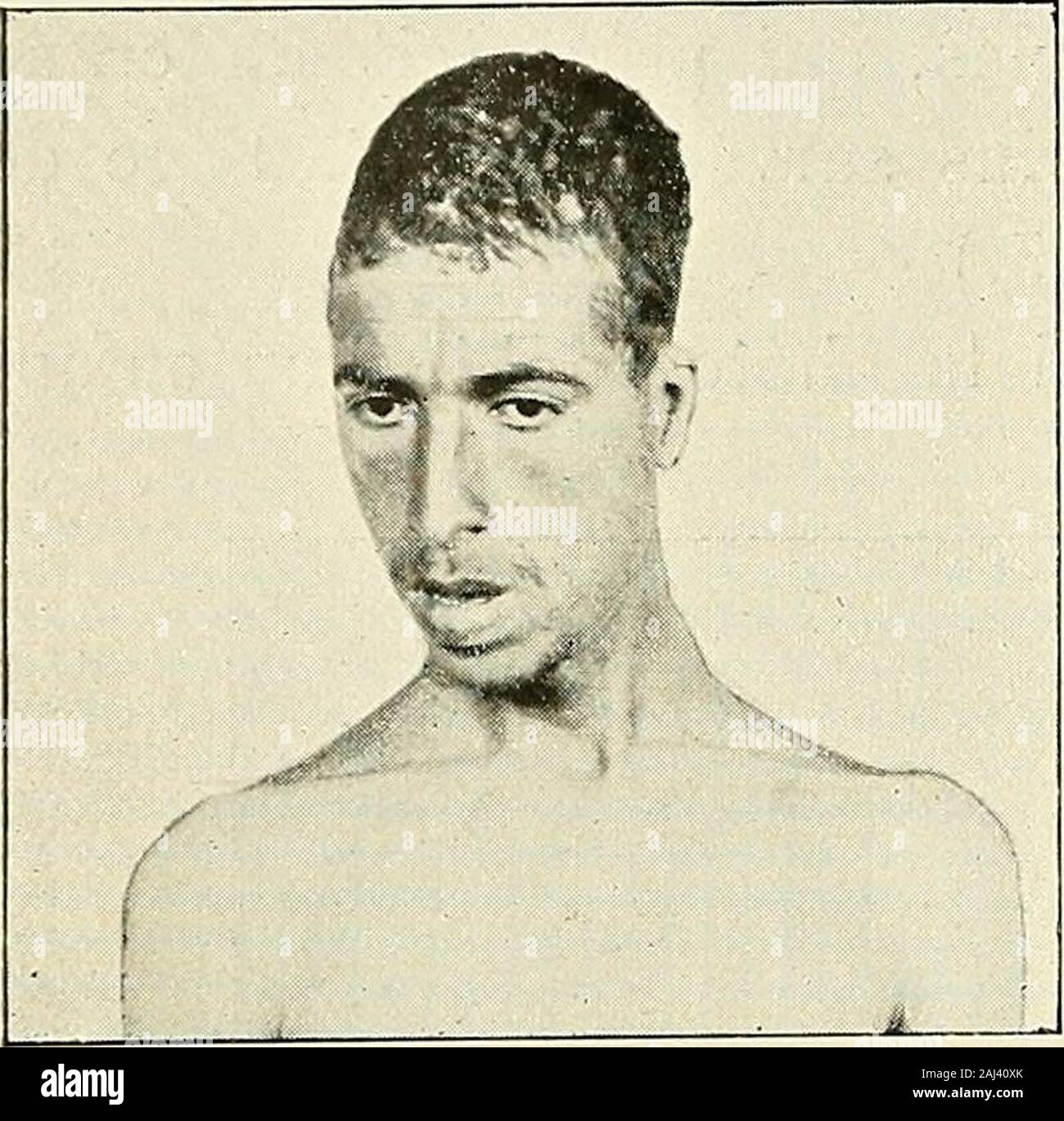 Recherche et Diagnostic de l'hÃ©rÃ©tun - Syphilis tardive. © Zteilnehmer (Voy. Abb. 15). (Beobachtung communiquÃ©e par le professeur Spillmann, deNancy.) 2 Le Kran, MICROCÃPHALE dobscrvation beaucoup plus raredans lhÃ© rÃ©tun - Syphilis; 5 Et-Instruments variÃ©tÃ©s rares, connues Sous les noms de crÃ neDOLicocÃPHALE, Ã diamÃ¨tre autÃ©ro-postÃ © ricur exagÃ©rÃ©; de crÃ ne 4 FOURNIER. 50 STIGMATES CRÃNIENS. SCAPHOCÃPHALE, qui n> St que ramplifÃ®-kation de la forme prÃ© Cà©-dente; de CRÃNE ACROCÃPHALE OU crÃ¢ue À voÃ "te notablement sur-Ã©levÃ© e, comme le Montre la Abbildung 14 (*). C. Ces diverses variÃ©tÃ©s Stockfoto