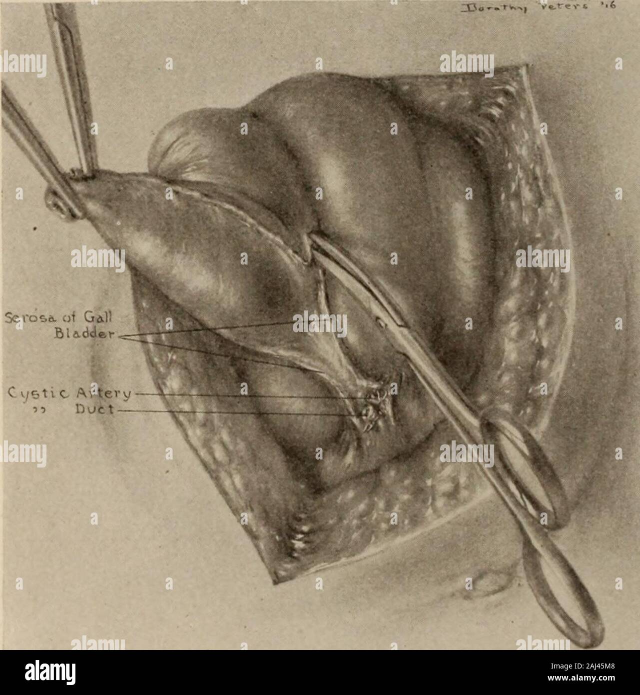 Interstate medical journal. ted Gall - Blasen; Anhänger; gallbladders Verwachsungen an den pylorus (Lund); gangrenousgallbladders; in frühen malignen Erkrankungen der Gallenblase selbst beschränkt. Kehrurges cholezystektomie als Prophylaxe in den Fällen chronischer Cholezystitis whichprove rebellisch zu medizinischer Behandlung. Mehrere (Mayo, Judd, Lathrop, Gibbon, 766 INTERSTATE MEDICAL JOURNAL und andere) die Aufmerksamkeit auf die Möglichkeit einer gemeinsamen systemischen Infektion secondaryto Krankheit in der Wand der Gallenblase, so wie sie von Rosenow, andadvise cholezystektomie als Prävention hingewiesen. Verstopfung oder Unkenntlichmachung o Stockfoto