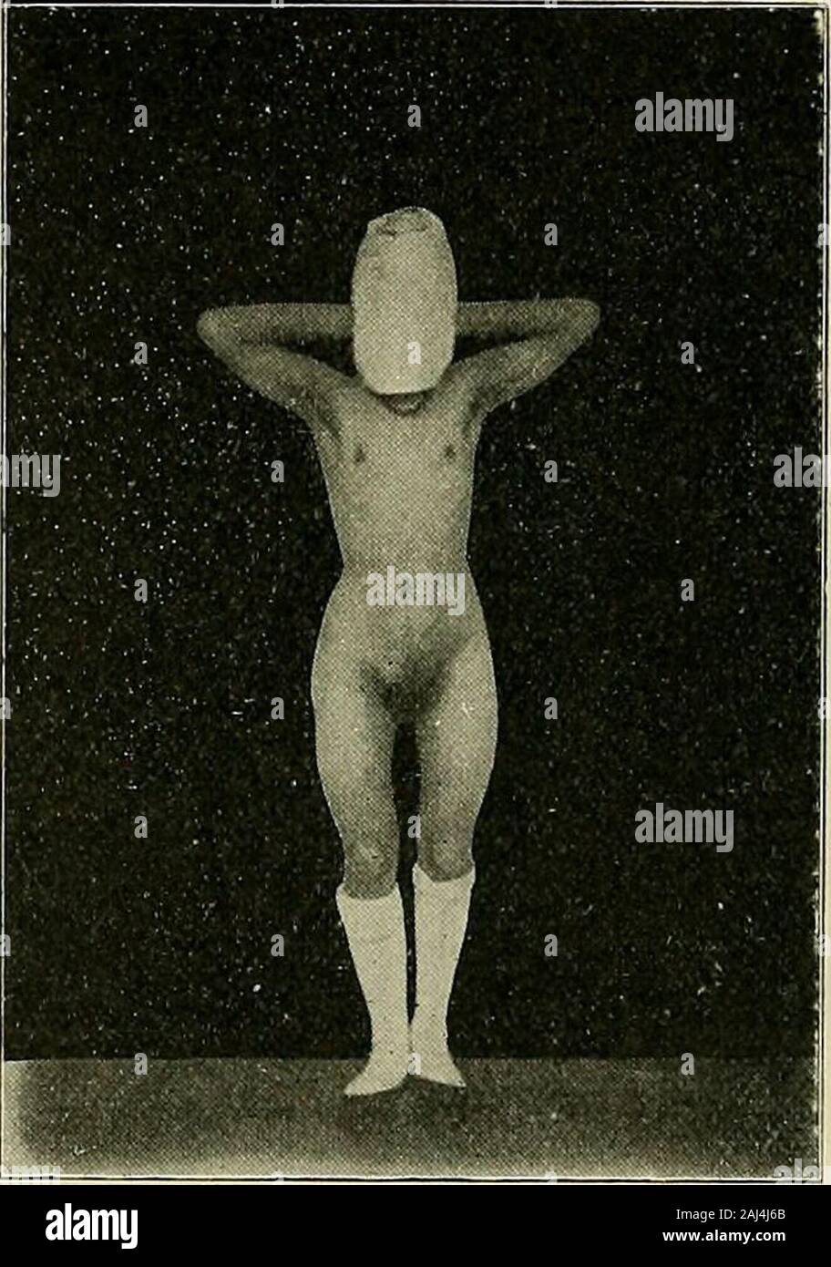 Hermaphroditismus beim Menschen. Abb. 27&gt;. (Zu Beob. 498.8-420-sichtbar, welche eine ganz feine Sonde1-l1/., mm Tief einlassen. Fandich nirgends eine Spur der äußeren Mündungen der Deferentia bzw.. Ductus ejacu - latorii. Der rechtsseitige Hode, etwa 3 cm lang, Krieg etwas größer als derlinke. Sterben lagen beide Hoden vor den Öffnungen der Leistenkanäle, ließen sichaber leicht um 4 - 5 cm in die großen Schamlefzen herabdrängen derSamenstrang gespannt, wobei sich antastete. Einen Uterus suchte ich vergeblich, konntemir damals überhaupt nicht klar werden, wofür ich ein Pro Rektum getastetes Stockfoto