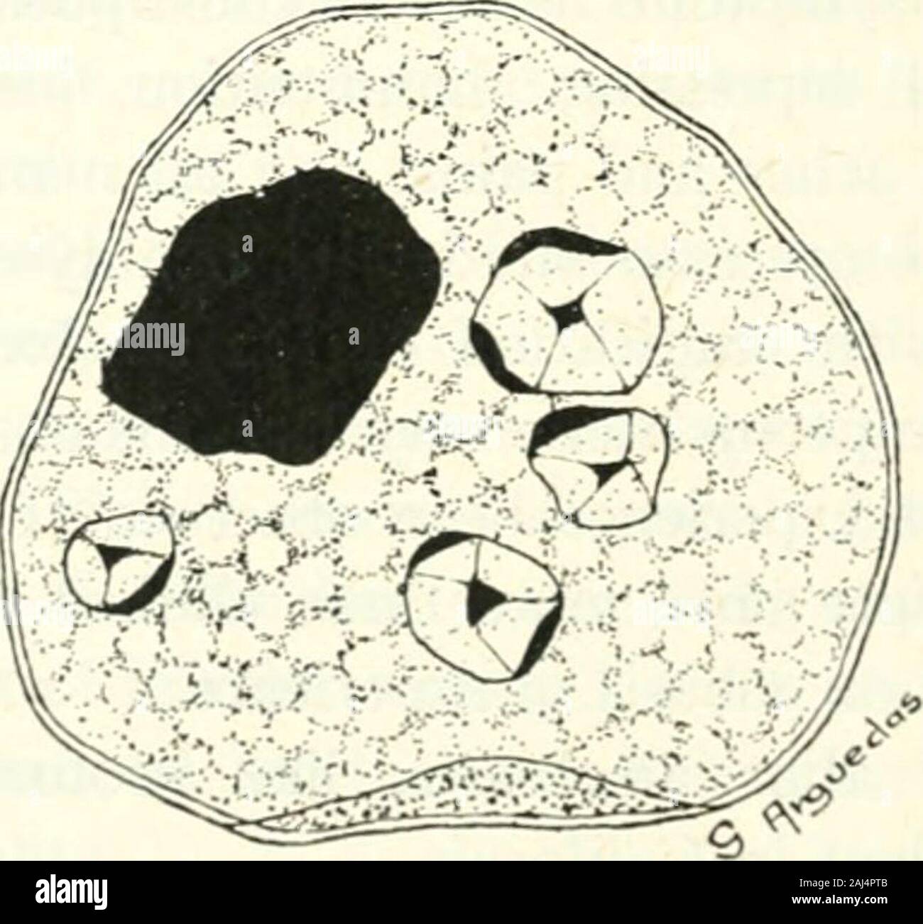 Die Medizinischen Kliniken in Nordamerika. Abb. 96,- Entamoeba histolytica. Abgerundet. Über das Feld, als wenn mit einem bestimmten Ziel. Die pseudopodiawhich es heraus wirft fast continuouslv in Richtung. Abb. 97.- Entamoeba histolytica, Encysted bilden. Fortschritte zeigen wenig Differenzierung vom gräulich, finelygranular Protoplasma. Darmprotozoen IN DER KLINISCHEN PRAXIS 409, zu anderen Zeiten er weniger aktiv ist, verläuft aber wenig anydirection. Es wird mehr oder weniger abgerundet und wirft offhyaline pseudopodia, nur langsam, sie zurück zu ziehen und andere toform an einem anderen Punkt. Th Stockfoto