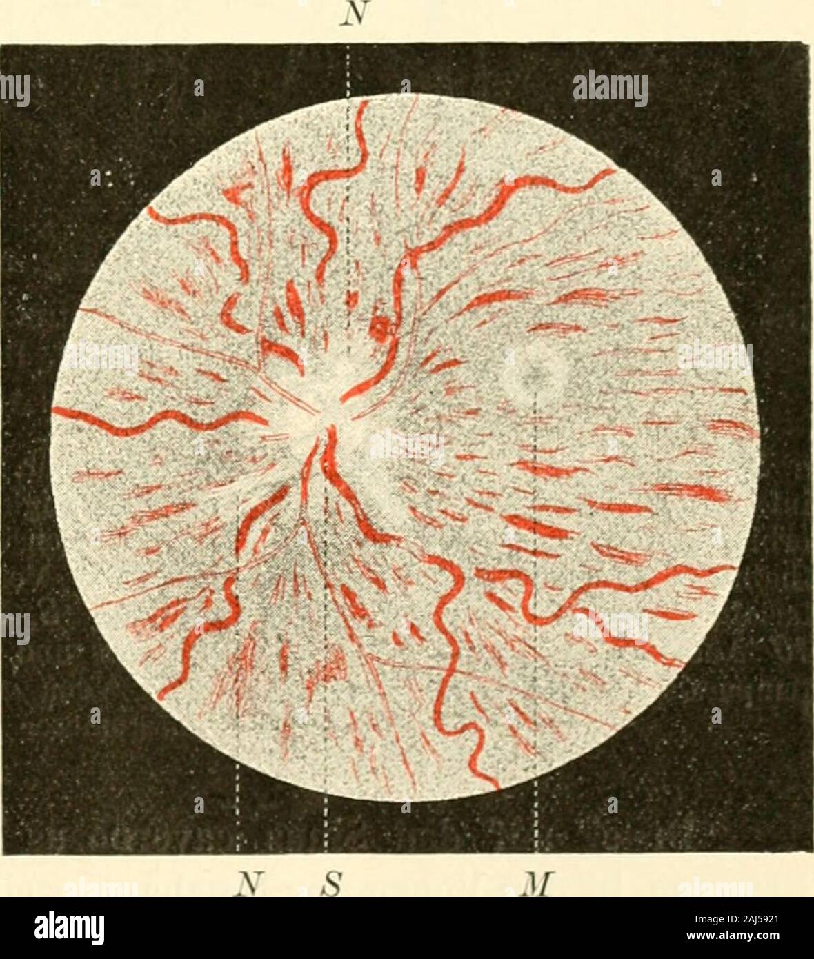 Die Neurologie des Auges ein Handbuch für Nerven- und AugenÃ¤rzte. ¶Tet, bin on the left side Auge ein-zelne Extravasieren in der NÃ¤er des Seh-nervenrandes. Makroskopische Betrachtung zeigte undmikroskopische dasBild einer Eiterigen Meningitis des Seh-nerven, Ansammlung von EiterkÃ¶rper-chen in der Höhle subarachnoidalen RÃ¤umenam reichlichsten, dann in der Pia, imsubduralen RÃ¤ume und in der Dural-scheide Sterben. In der Höhle PialfortsÃ¤tzen warenbald ungemein strotzend mit Blut ge-fÃ¼llte GefÃ¤sse wahrzunehmen, hÃ¤ufigeraber Extravasieren, welche das Bindege-webe der PialfortsÃ¤tze vollstÃ¤ndig ver-deckten. Je mehr ma Stockfoto