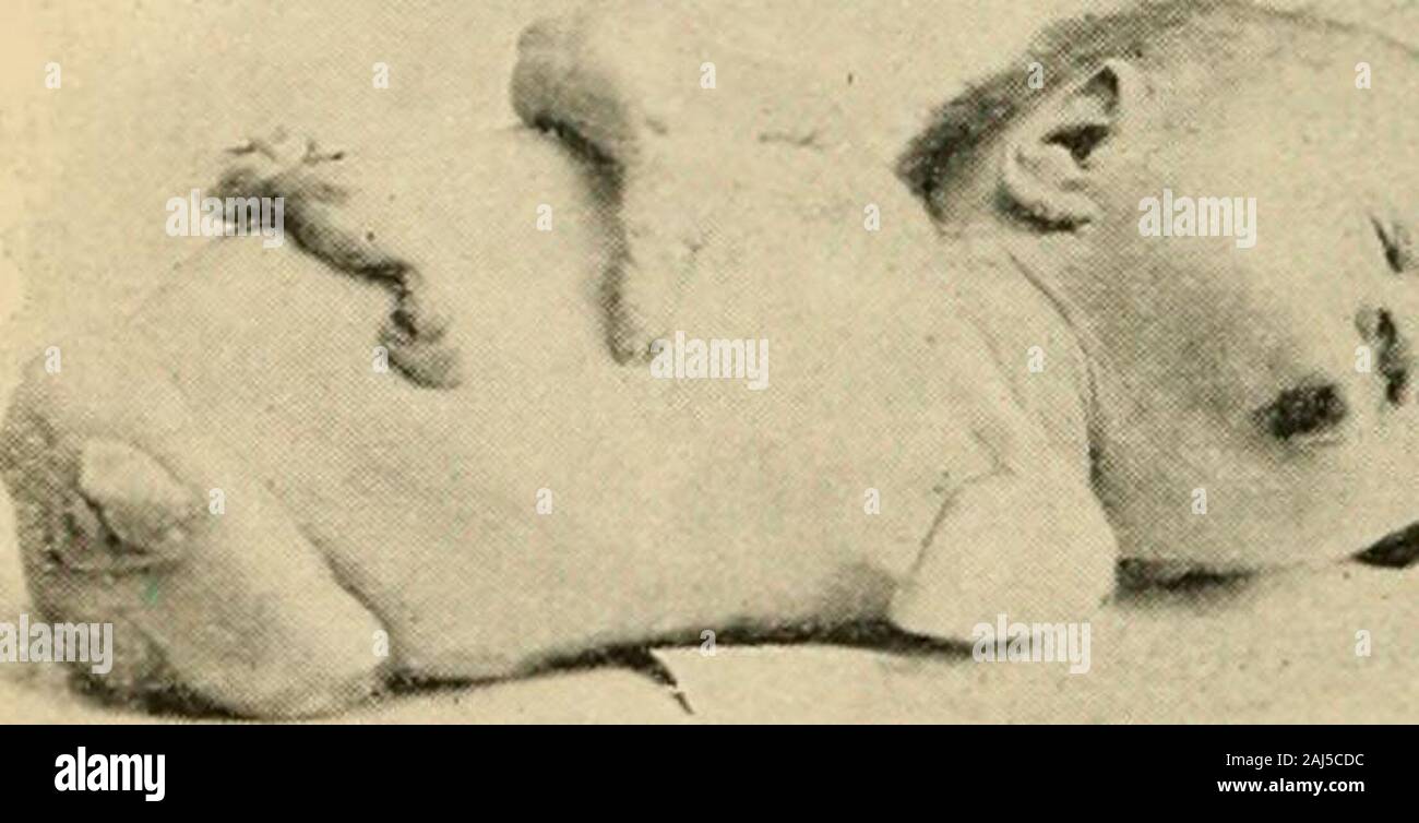 Ein Handbuch der Geburtshilfe. d spoiitaneojts orintrauterine amputationsof fetalen Teile (Abb. 88). Ein dichtes Band oder foldof bethrown das Amnion kann über ein Glied des Fötus und von Con-stricting die Zirkulation kann das Wachstum und die Entwicklung des distalen Teil, die entweder kom- plett getrennt werden kann oder nur verzögert in seinem Wachstum und causedto durchlaufen einen Atrophischen Prozess. Komplett im Koffer amputa- erfolgt der abgetrennte Mitglied werden wahrscheinlich entirelyabsorbed werden, wenn sich der Unfall vor dem thirdmonth der Schwangerschaft passiert ist; wenn die Amputation aufgetreten ist später inpregnancy, die getrennt p Stockfoto