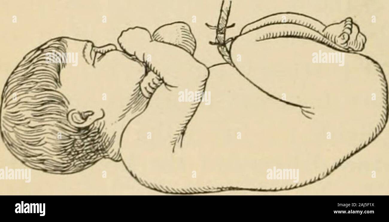 Ein Handbuch der Geburtshilfe. Er vulvar Drossel in schneller Folge, so wird die Hand des theassistant folgt die Vertragsparteien Gebärmutter relaxationand postpartale Blutung zu verhindern. Die Atmung wird etabliert, das Kind schreit, die Herzen handeln wird regelmäßig, und in ein paar Momenten die Schnur aufhört zu schlagen. (3) Verbindung der Kabel. - Das Netzkabel sollte Ligiert onlyafter werden die pulsationen völlig aufgehört haben; Sofortige ligationafter Geburt ist sagte der fetalen Zirkulation von leastthree Unzen Blut zu entziehen - ein erheblicher Verlust in schwachen andanemic Kinder. Die wünschenswertesten Ligatur ist eine kleine Band, die Stockfoto