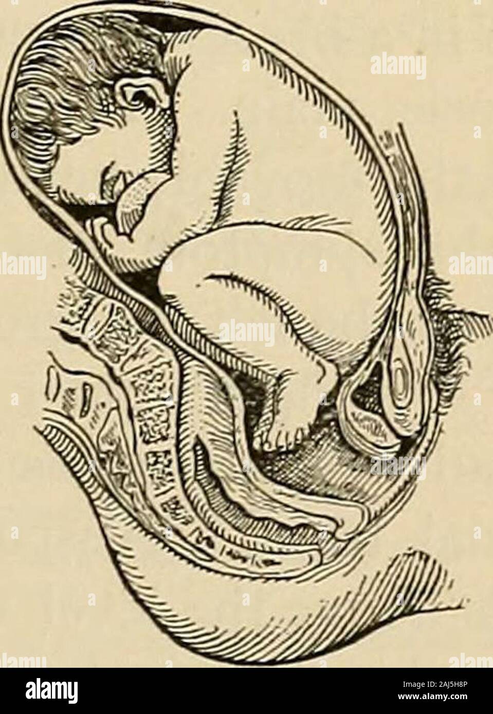 Ein Handbuch der Geburtshilfe. Abb. 67. - Knie Präsentation.. Abb. 68.-Fuß-Präsentation. Fast vollständige Extension der unteren Gliedmaßen, constitutingthe sogenannte Fuß oder footling Präsentation (Abb. 6^): Dabei ist unerheblich in etwas mehr als ich Prozent aller Steißlage Fälle, und isprobably aufgrund eines plötzlichen Flucht von Liquor amnii in einem normalbreech Präsentation, unten mit sich trägt die Prolapsed Extremität; oder es kann von den heftigen Bewegungen des Kindes führen. Ursachen ofBreech Präsentation. - Im Hinblick auf die Ätiologie der Becken- Pres - 148 EIN HANDBUCH DER GEBURTSHILFE. Entations viel geschrieben wurde. Unter den am meisten probablefactors in Ihrer Stockfoto