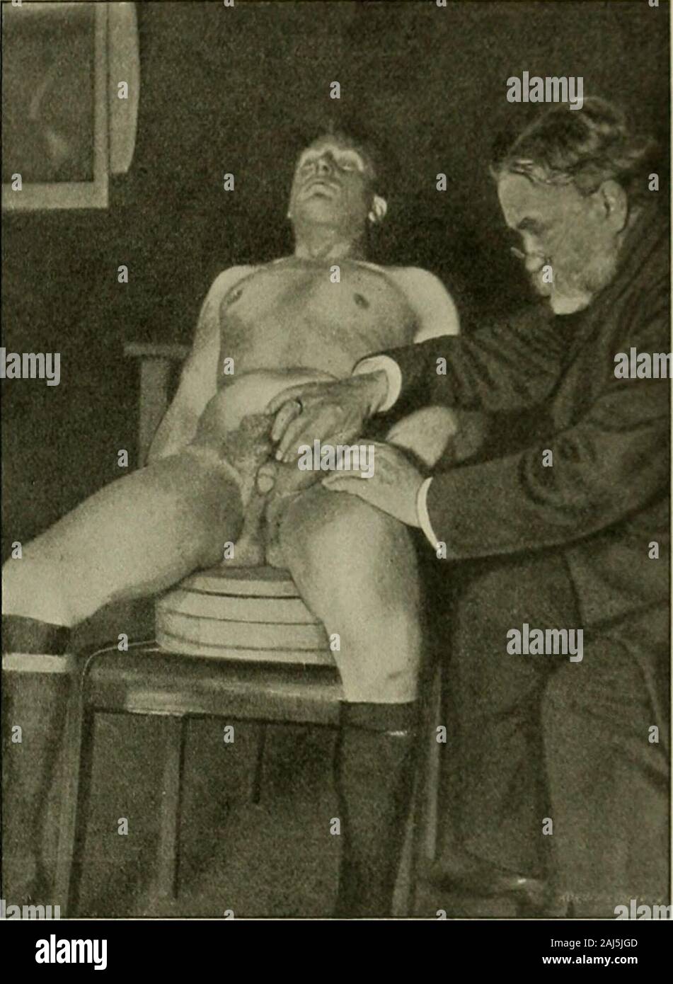 Hermaphroditismus beim Menschen. Lehrwerk. Abhandlungender KÃ¶niglichen Gesellschaft, Christian zu Göttingen. 1845. Bd. 1, Bl. II, S. 104. (Beob. 87.) Neonat, Glatze verstorben. Hypospadiasis sinusurogenitalis peniscrotalis, l1/Â" Zoll lang. Uterus unicornis, links Rohr, Ovar und Ligamentumrotundum vorhanden. Der Gebärmutter, gut ausgebildet, mÃ¼ndet in den Sinus uro-Genitalis. In der rechten Hoden und Nebenhoden Schamlefze, das Vas deferenszieht durch den Leistenkanal zum Uterus hin und verlÃ¤uft in dessen Wandherab bis zum Sinus urogenitalis, wo es eine halbe Linie / auÃen von 107 Urctlira Stockfoto