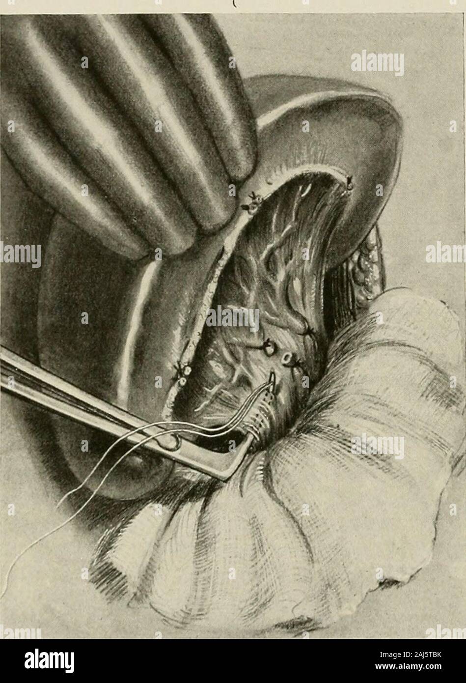 Chirurgische Behandlung; eine praktische Abhandlung über die Behandlung von chirurgischen Erkrankungen, für die Verwendung von Praktikern und Studenten der Chirurgie. n, mit zwei Todesfälle. Die Verbesserung im Blut pictureafter Operation wird oft auffällig. E. B. Krumbhaar (Jour. Standort. Med. Assoc, Sept. 2, 1916) gesammelte Informationen über 153 patientswhose Milz für perniziöse Anämie entfernt wurden: 19,6 Prozent, diedwithin sechs Wochen; 64,7 Prozent, wurden verbessert; 15,7 Prozent, VOL. II - 786 chirurgische Behandlung nicht verbessert, keine Waren zu vollkommener Gesundheit wiederhergestellt. Die besten Ergebnisse aresecured Wenn die Operation vorangestellt ist Stockfoto