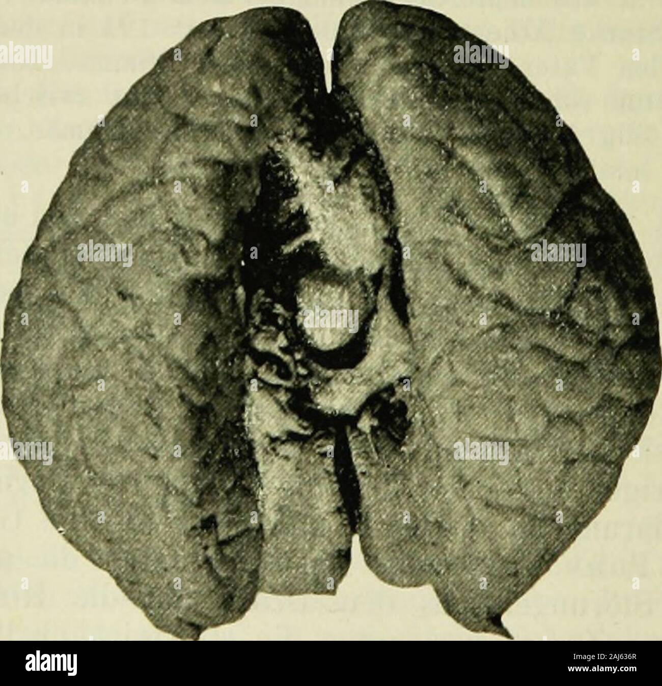 Diagnostik der Geisteskrankheiten fuÌr praktische AÌrzte und Studierende. Anfangs festgestellte temporale Hemianopsie vielleicht als Untersuchungs-Fehler aufgefasst werden konnte. Abb. 14 b .. Es wurde auch ein Tumor in der mittleren Hirnpartie in der NÃ¤heder VierhÃ¼gel angenommen, Wärtsilä hrend neben of this Annahme sterben Localiza- tion an der Basis, Speciell an der Hypophyse, am wahrscheinlichsten Krieg. Apoplexie und Erweichung. 1 S 1 Würfel Abschnitt lÃ¶ste das diagnostische RÃ¤thsel in folgender Weise: Eine Stelle der ZirbeldrÃ¼se¶ Das Lbt sich (s. Abb. 14 a) eine knollenÃ¤hnliche Ge- schwulst (Sarkom/) vor. Das Stockfoto