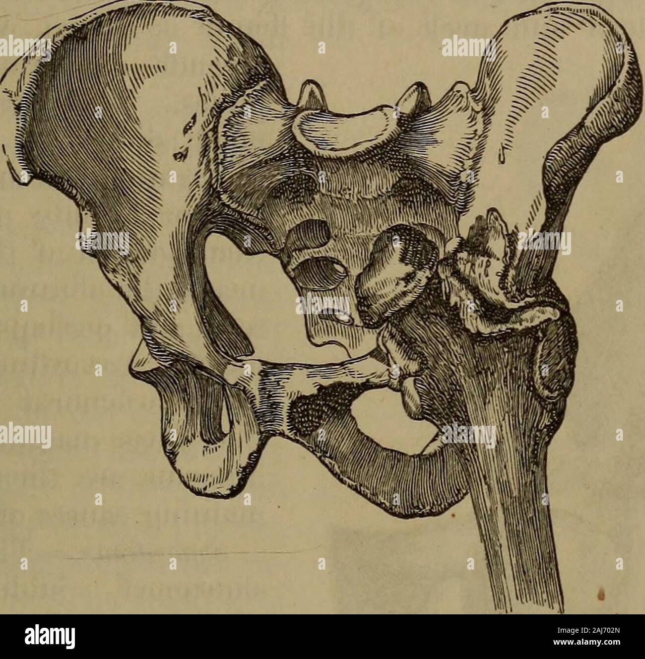 Eine praktische Abhandlung über Brüche und Verwerfungen. Effekt der Beugung auf dem ilio-Femoralen ligament inder Schilddrüse Dislokation. (Von Bigelow.) NACH OBEN UND NACH VORN AUF DIE PUBES. 715 wie in einem Fall vom Ende des Wagens, der Fuß wird instinctivelythrown nach hinten um den Kopf zu speichern; oder es kann passieren zu Aperson, der, beim Wandern, plötzlich setzt einen Fuß in ein Loch, in Con-Sequenz, die die Becken Fortschritte, aber das Bein und den oberen Teil des Körpers Neigung gewaltsam nach hinten. Gelegentlich hat Es fromfall auf der Rückseite des Beckens führte, oder auf einen schweren Schlag erlitten upont Stockfoto