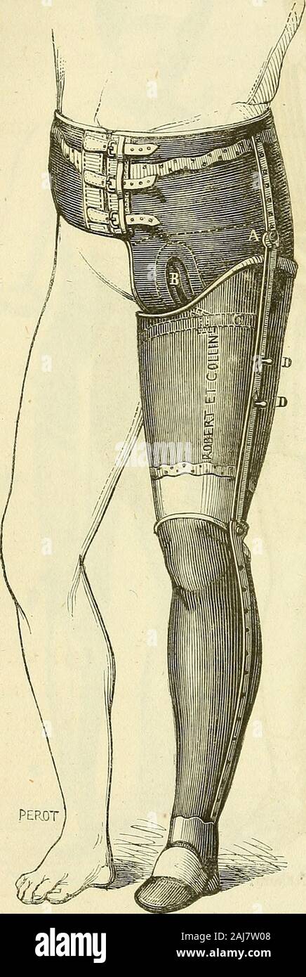 Arsenal de la Chirurgie contemporaine: Beschreibung, Mode d'Emploi et appréciation des appareils et Instrumente en Nutzung pour le Diagnostic et le traitement des maladies chirurgicales, l'orthopédie, La prothése, Les opérations simples, générales, Spéciales et obstétricales. nt à ceux pour queTon emploie lamputation de la cuisse, Mais qui Unit le cuissart larticulation à lacoque pelvienne est Digne dattention. Lat-telle fémorale externe est seule articuléepar un Boulon de A, avec une attelle placéesur Le Côté externe de la Coque; lattellefémorale interne se Termine au niveau de lacoque sans êt Stockfoto