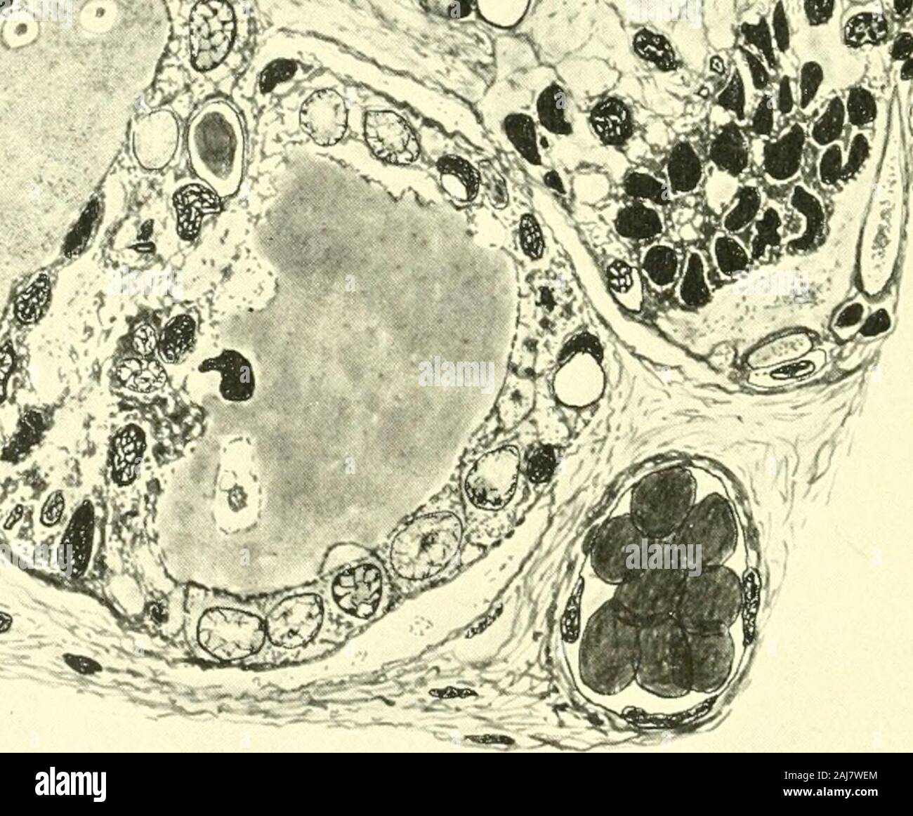 Das amerikanische Journal der Anatomie. r-^^^^^--^^"&gt;&gt;. Abb. 9 ein Teil der gleichen Schilddrüse ghmd in figureG gezeigt (Ratte Nr. 11,64, Wartung von 21 auf 73 Tage alt), vergrößert, um Details der histologicalstructure zeigen. Dieser Bereich stellt Fortgeschrittenen follikulären Degeneration. Die Zellen in den verschiedenen Stadien der Degeneration und Zerfall. Tendenz des-quamation mit Zerstörung der Kolloid- und Obliteration der Follikelreifung Hohlraum. Karyolytic Somenuclei angezeigt, obwohl karyojjycnosis pred(miinates und karyor - rhexis häufig angezeigt wird. (X 750.) INANITION DER SCHILDDRÜSE BEI RATTEN 319 111 Die Stockfoto