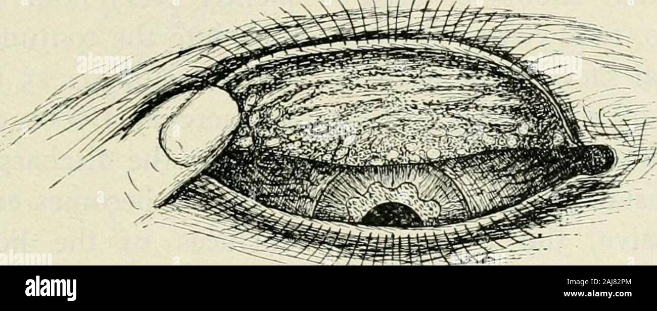 Die gemeinen Krankheiten des Auges: Wie zu erkennen und wie sie zu behandeln. Typische granulare Deckel und Anfang Narben, mit Pannus. Und durch eine Anzahl von weißlich Linien, die zeigen, dass die Bindehaut durch Bindegewebe ersetzt wurde geschnitten. Als die Krankheit noch weitere Fortschritte othercomplications ergeben. Die okuläre Bindehaut- verstopft und eine vaskuläre Zustand des thecornea auftritt, die zu einer Bedingung calledpannus, die nichts mehr oder weniger als theextension Der trachom auf die Hornhaut. Dieschraube der oberen Teil der Hornhaut ist generallv der ersten GEMEINEN KRANKHEITEN DES CONJUNC Stockfoto