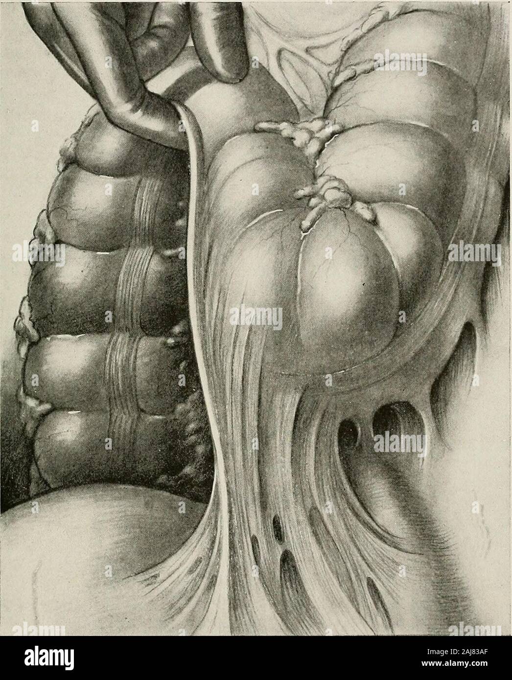 Chirurgische Behandlung; eine praktische Abhandlung über die Behandlung von chirurgischen Erkrankungen, für die Verwendung von Praktikern und Studenten der Chirurgie. ns kann causefixation der sigmoid und Verstopfung, die nur durch Division der Adhäsionen und Wiederherstellung der Mobilität von thebowel (Abbn isrelieved zu eigensinnig geben. 1252 und 1253) (siehe Peritoneale Adhäsionen, Seite 520; andChronic intestinale Stasis, Seite 610). Ventil ileocecal Hindernis ist nicht selten als abweichenden Fest - DER BAUCH 603 ness des Ventils, die dilatation des Ileums, ileal stasis und oftensymptoms ähnlich Blinddarmentzündung gesehen. Stockfoto
