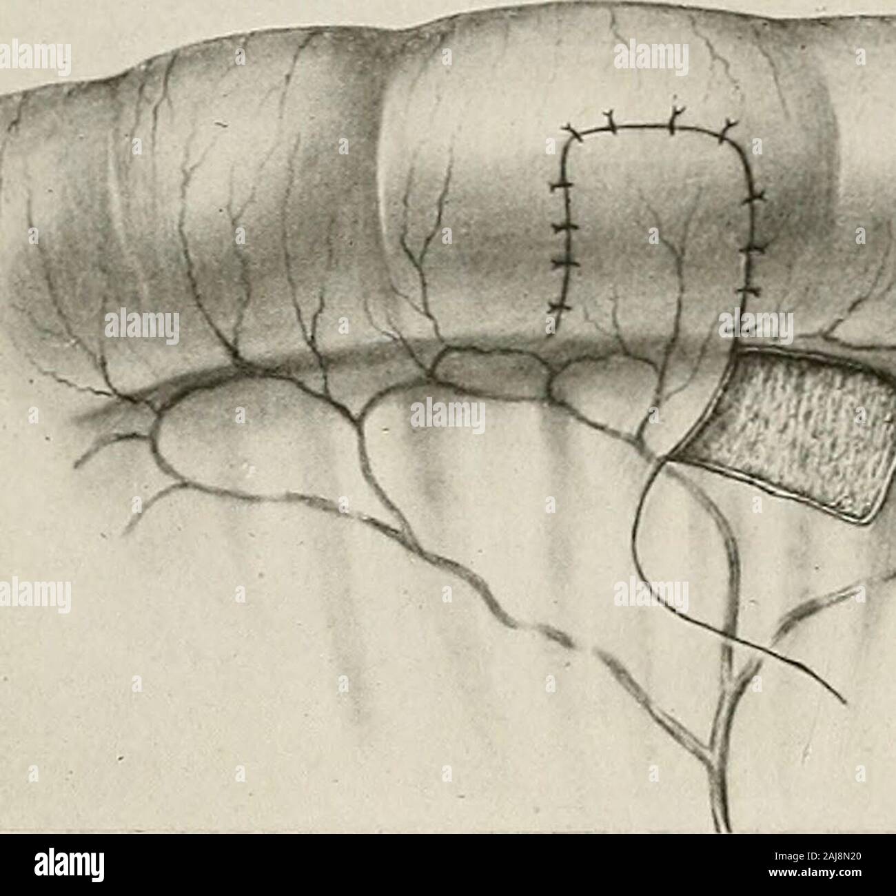 Chirurgische Behandlung; eine praktische Abhandlung über die Behandlung von chirurgischen Erkrankungen, für die Verwendung von Praktikern und Studenten der Chirurgie. Er systemische Zirkulation um das hepaticobstruction. Alle vernähung der peritonealen Oberflächen, so wichtig in Magen und intestinaloperations, hängt ab von der Reizung durch die Einschnitte durch theperitoneum und auf die Reizung der Nähte, die Wunde unddie Nähte mit Kunststoff Fibrin innerhalb von ein paar Stunden oder sogar Minuten, nachdem in der Nähe der Operation. Aseptische Fremdkörper in das Bauchfell thusbecome Links gekapselt (siehe Adhäsionen, Pa Stockfoto