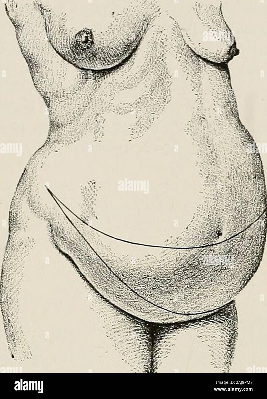 Chirurgische Behandlung; eine praktische Abhandlung über die Behandlung von chirurgischen Erkrankungen, für die Verwendung von Praktikern und Studenten der Chirurgie. Ision mit ihrer Konvexität oberhalb der Pubes gemacht werden sollten. Durch die Zeichnung die Gewebe oben, es kann geschätzt werden, wo die upperincision vorgenommen werden soll. Die exzision sollte auf die fasciacovering der Muskeln (Abb. durchgeführt werden. 1204). Die Öffnung in der Haut sollte einige sein - was größer als der Boden der Wunde gute Annäherung zu geben. Entlüften sollte durch feine Ligaturen überprüft werden. Die Wunde sollte byrunning Nähte von catgut in einer oder mehreren Stufen geschlossen werden. Stockfoto
