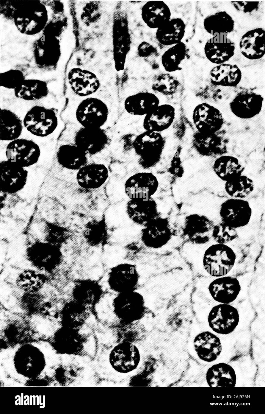 Eine mechanistische Auffassung von Krieg und Frieden. 5"&lt;?^^M^V? Abschnitt des kleinhirn eines Soldaten, die Hunger, Durst gelitten hatte, und der Verlust von Schlaf; hatte die außerordentliche Gewaltmarsch von i 8o km von Mons, der Marne; inmitten der größten Schlacht in seinem -. Ory wurde durch die Explosion von ashell verwundet; für Stunden warten auf Hilfe, und di^ni aus Erschöpfung bald nach reachingthe Krankenwagen. Vergleichen Sie die blass-out erschöpft Purkinje Zellen, erklärte byarrows, mit den Purkinje Zellen in einem, auch durch Pfeile gekennzeichnet. Abschnitt der normalen Nebennieren (x1640) Stockfoto