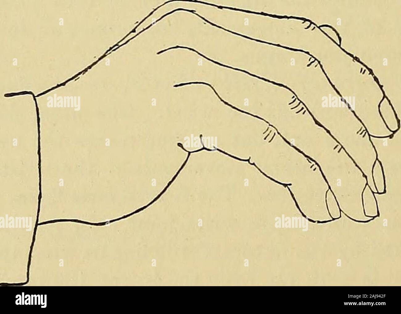 Ein Handbuch von Krankheiten des Nervensystems. ist Dieser extensor, die Hand seitlich abweicht, wenndie Daumen ist stark erweitert. Streckmuskeln der Finger. - Extensor digitorum communis; E. indicis; E. minimi seiner antireflektiven (muskulo-Spirale Nerv). Die gemeinsame Extensor thefingers bewegt und dann das Handgelenk. Wenn der Muskel ist beginsat faradised, die Erweiterung der distalen Phalangen, und diese wieder ausgelenkt werden, wenn die Hand über die Ebene der Unterarm isextended, von der Tonika Kraft Der beugemuskeln, die im Laufe der Sehnen durch die Erweiterung der Handgelenk gestreckt wird. Darüber hinaus wird der Muskel hat wenig ac Stockfoto