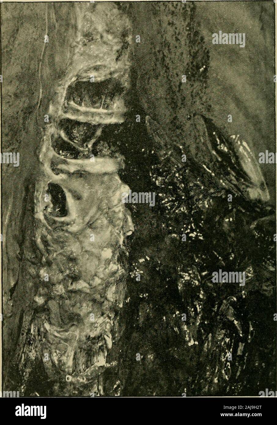 Medizinische und chirurgische Berichte. Abb. 2. - Foto der Brust- und Bauchhöhle, nachdem alles removedexcept der Aorta, der Tumor und die linke Niere. Die aorta ist aufgeteilt worden, und onits posterioren vi/Alle gesehen wird die Öffnung auf die im Text verwiesen wird. Die linke Niere liegt vor, und der Tumor, der in hohem Grade beleuchteten Teil der Masse auf der linken Seite der Bauchhöhle. Ein Director ist in der linken gemeinsame Darmbein Arterie platziert. Das folgende ist eine Auswahl aus den Aufzeichnungen des autopsymade von Dr. Mallory: Ahdorniu/D-Buchse. - Eine Reihe von dunkel, strähnig clot Stockfoto