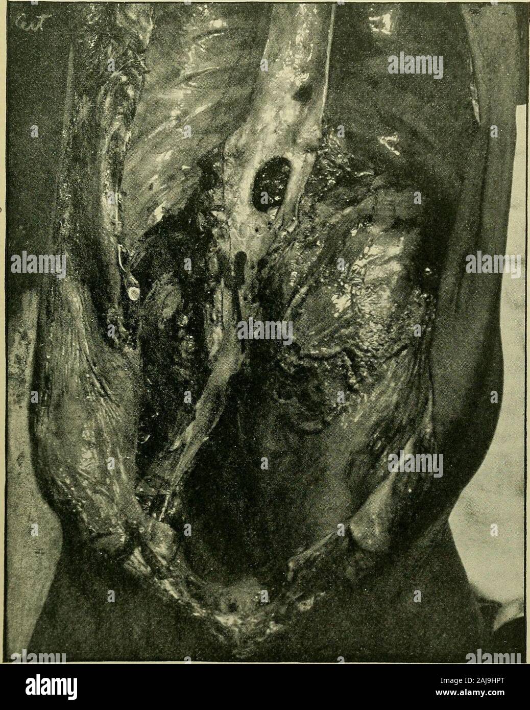 Medizinische und chirurgische Berichte. Es scheint, dass etwa drei Monate, bevor sie ins Krankenhaus hefirst bemerkt, eine Schwellung im Bauch. Diese Schwellung erhöhte insize bis zu seinem Eintritt in das Krankenhaus. Auf der linken Seite der mans Bauch, und Verlängerung von thecostal Grenze zu Pouparts Ligament, war eine solide Tumor - nicht beweglich, nicht ausgeschrieben. Es hatte eine ausgeprägte expansile Pulsation. Es war langweilig onpercussion, und nichts Endgültiges könnte auf Auskultation gehört werden. Der Mann lag im Bett, in der linken seitlichen Dekubitus, mit seinem linken hipslightly auf dem Abdomen ausgelenkt. Das Knie war auch gebogen. Th Stockfoto