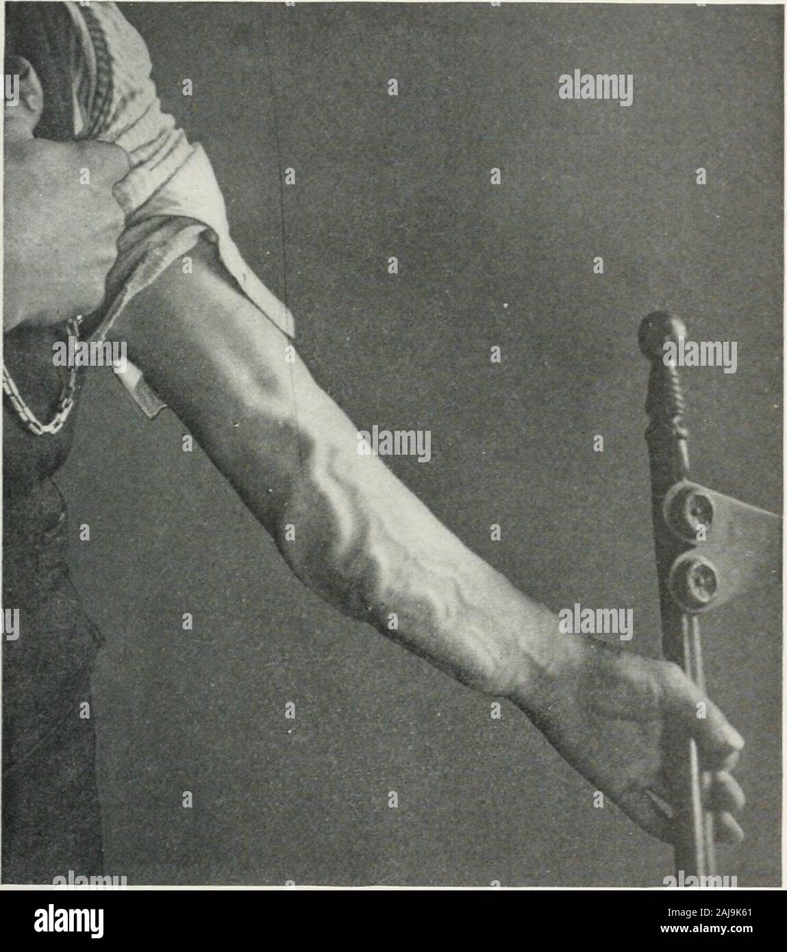 Annalen der Chirurgie. Die weniger permanente Dilatation und tortuosityhas in den betroffenen Venen verursacht worden. In sehr alten Fällen, insbesondere wenn die Aus geschossen - Wunden, die Bedingungen zum Zeitpunkt der Operation können solche asto werden keine formalen Verfahren äußerst schwierig. Ich habe einen solchen Fall am Ellbogen auftretenden zu berichten - Gemeinsame, durch eine Gebühr von buckshot im Nahbereich verursacht, Herstellung von acompound Bruch des unteren Endes des Humerus withsloughing der meisten weiche Teile über die Gemeinsame. Healingwas viel verzögert, und Pulsation wurde bemerkt in der woundbefore es vollständig geschlossen wurde. Der Mann fin Stockfoto