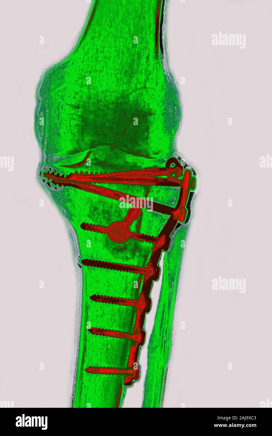 Osteosynthese am Schienbein Stockfoto