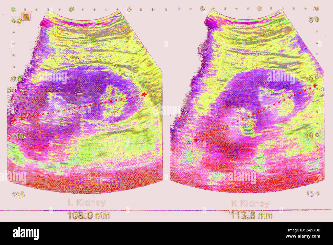Kidneus Ultraschall Stockfoto