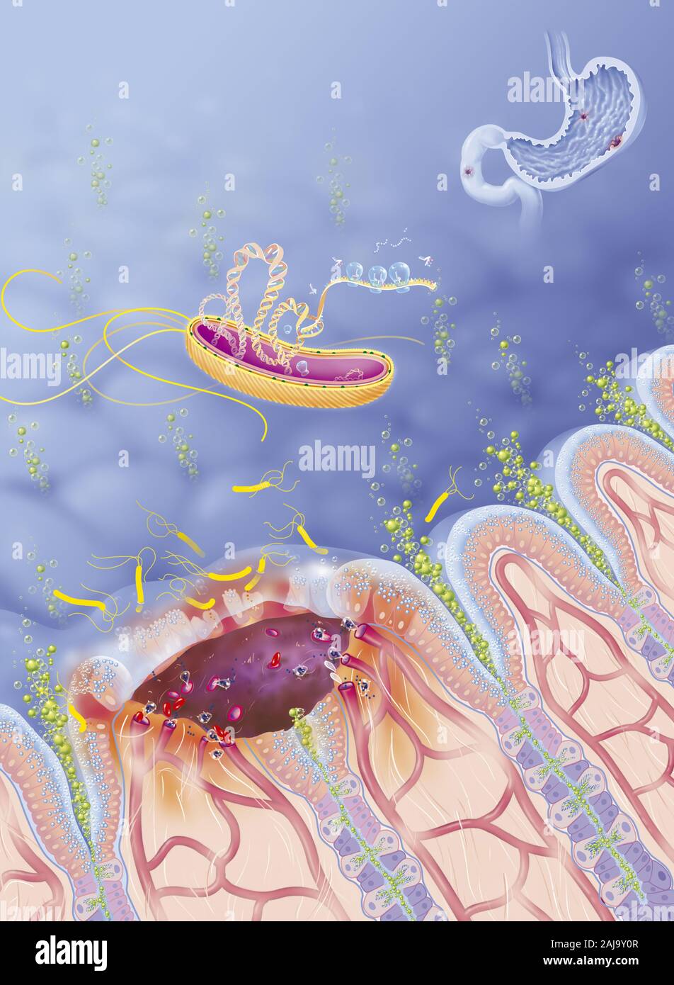 Ulcere gastroduodenalen Stockfoto