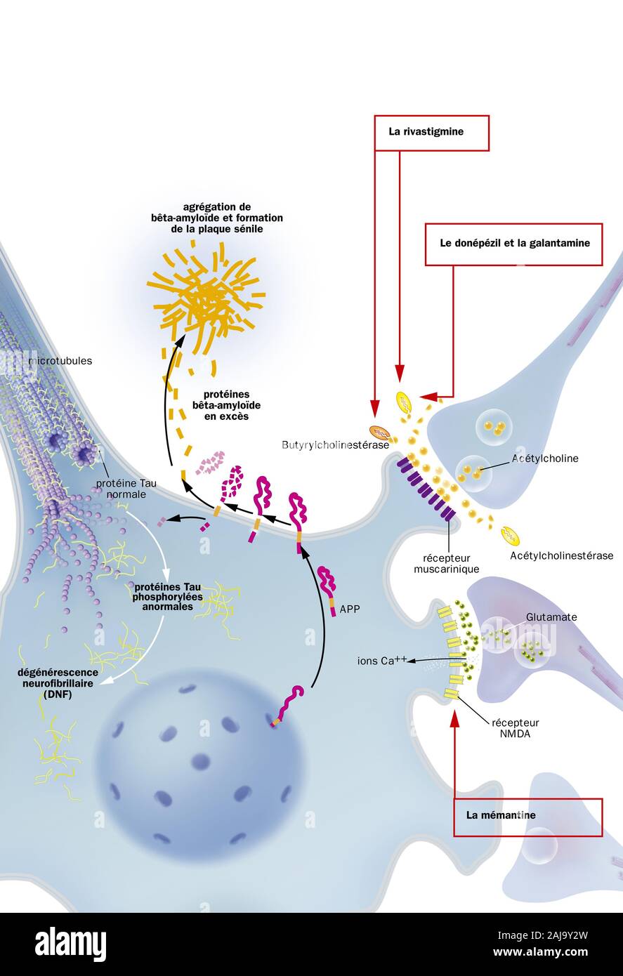 Mit neurofibrilläre Degeneration Prozess Neuron, senile Plaques, Behandlungen. Neuron im zentralen Nervensystem durch abnorme Spaltung von APP betroffen Stockfoto