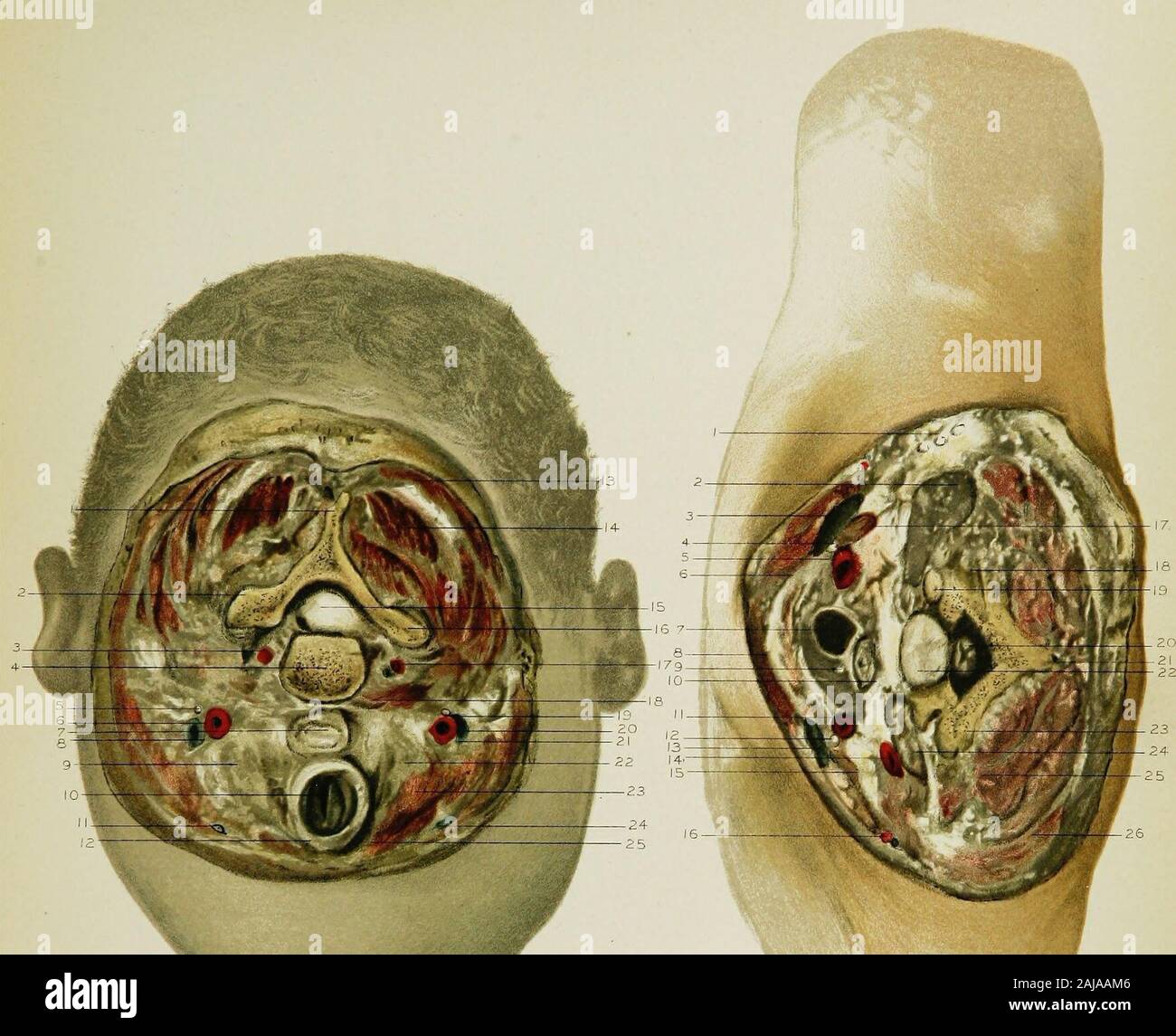 Regionale Anatomie in ihrem Bezug zur Medizin und Chirurgie. Der Sternalen Ende des Sterno-mastoid Muskel. 7. Die Luftröhre. 8. Die Sterno - Schilddrüse und Sterno-hyoid Muskeln. 9. Die immer wiederkehrende Laryngeal Nerv. 10. Die speiseröhre. 11. Der linken A. carotis communis. 12. Der linke Vagusnerv. 13. Die linke Innominate Vene. 14. Der linken A. subclavia. 15. Die linke scalenus anticus Muskel. 16. Die supra-skapulier Arterie und Vene. 17. Die richtigen scalenus anticus Muskel. 18. Die richtigen quer Prozess der ersten Brustwirbel. 19. Der Kopf der ersten Rippe. 20. Die Medulla spinalis. 21. Die sp Stockfoto