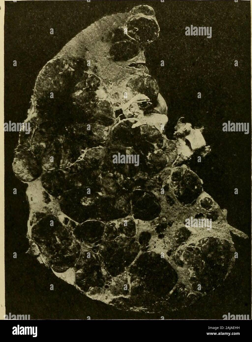 Medizinische und chirurgische Berichte. Er Knötchen sliow umbilication, sondern auf Palpation einige schlagen vor, Fluktuation, als wenn die zentrale portionswere viel weicher. Die Oberfläche der riglit von thefalsiformligament ist fast glatt im Gegensatz zu den grob tlie lobulatedappearance von anderen Teilen der Leber und ist mit manysnial weißlich und grünlichen Bereiche meliert, von denen keine Messen mehr als 0,5 cm. 174 KARZINOM DER LEBER. Auf dem Abschnitt (IV.) die Leber große und mittlere zeigt große, abgerundete Bereiche einer dunkelroten Farbe. Über einige dieser Es appearsto Werden unbestimmte angeschlossen sein. Stockfoto