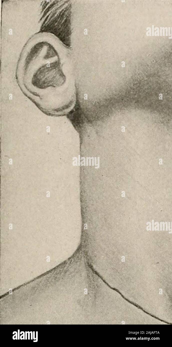 Chirurgische Behandlung; eine praktische Abhandlung über die Behandlung von chirurgischen Erkrankungen, für die Verwendung von Praktikern und Studenten der Chirurgie. Weiter ifted und befreit von der posterioren Anhänge. Die superior und inferior Schilddrüse Gefäße werden gesehen, Ligiert. (Nach Mayo.) Nach dem Sezieren kostenlos die beiden Nocken, so dass Sie vorwärts gebracht werden und lieupon der zurückgezogenen Muskeln die Landenge zwischen zwei forcepsin seiner schmalsten Teil (Abb. aufgeteilt werden sollten. 1083). Die stopfbuchse hat immer noch seinen hinteren andvascular Verbindungen. Jede Seite ist dann vom trachea.Complete Entfernung aller Drüse Gewebe seziert wird keine Stockfoto