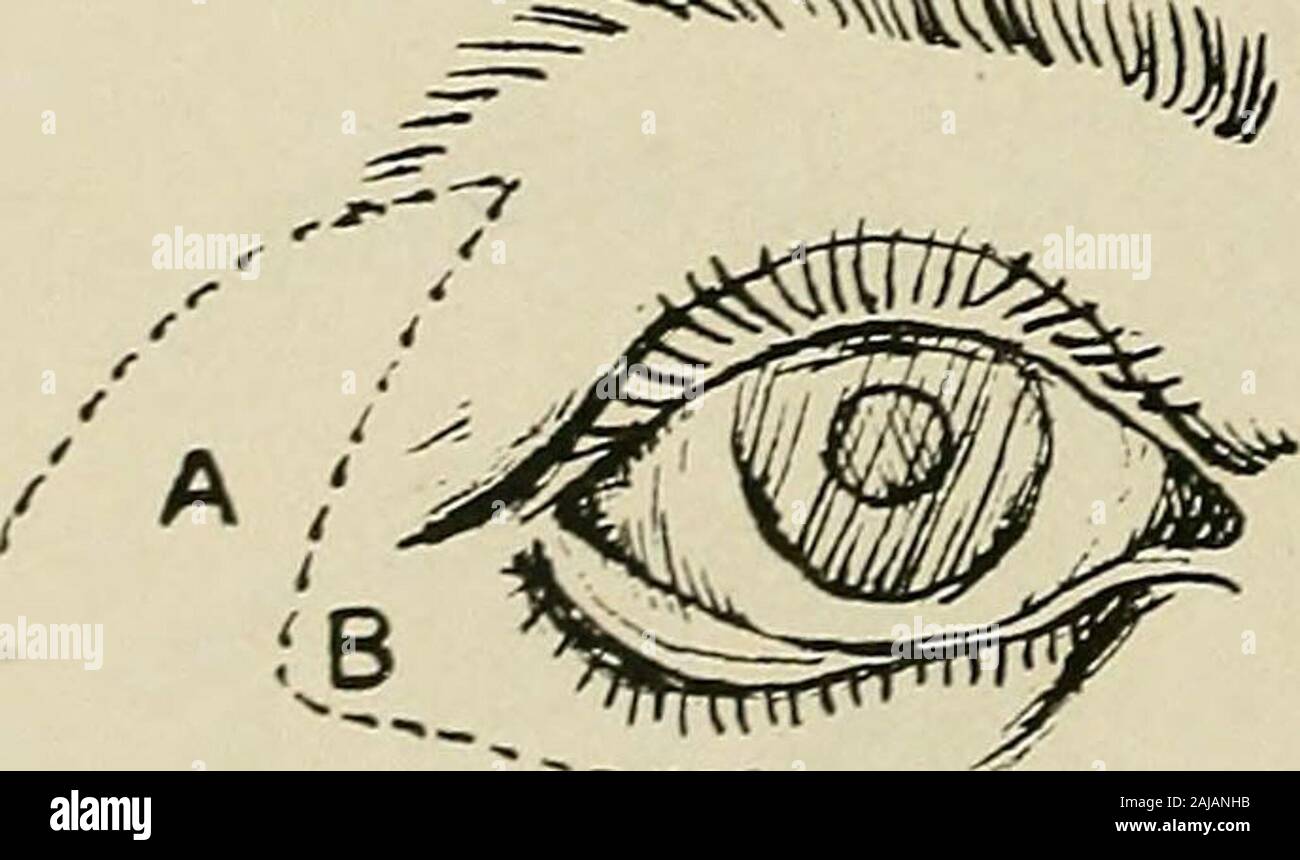 Plastische Chirurgie; ihre Grundsätze und Praxis. Abb. 348.-Lagleyzes Betrieb für ektropium des unteren Deckel {Bart, in Holz).- I. Die gestrichelten Linien zeigen die Umrisse der Klappen A und B. 2. Nachdem die Klappen haben beendissected und ektropium entlastet Sie überlagert sind und in der positionshown vernäht. Wiederherstellung der Augenlider die Abwesenheit der Augenlider, im Ganzen oder zum Teil, ist aufgrund von directtrauma, um die Ausrottung der bösartigen Wucherungen, die Zerstörung followingdisease, Syphilis, Tuberkulose, Geschwür, gangrän. ?^=^^^^^^^Vv. Stockfoto