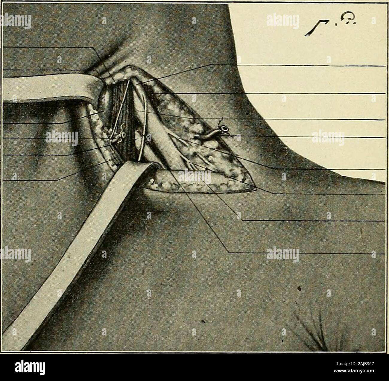 Eine Abhandlung über die orthopädische Chirurgie. an der Kreuzung der middleand unteren Drittel, nach unten und nach außen, damit das schlüsselbein an thejunction der mittleren und äußeren Drittel. Nachdem die Haut, platysma und tiefen Faszie aufgeteilt, die omohyoid Muskel ist^ Brit. Med. Jour., 1903, S. 298. = A. S. Taylor, J. bin. Med. Assn., Bd. 48, Nr. 2. 504 OETHOPEDIC SUEGEPiT. ausgesetzt in der Nähe des Schlüsselbeins, und darunter sind die supra-skapulier Schiffe. Diese Strukturen können eingefahren nach unten, oder, sofern der Fall es erfordert das extra Zimmer, die bedivided omohyoid kann, und dann die Schiffe zwischen doppelten Ligaturen schneiden. Thetr Stockfoto