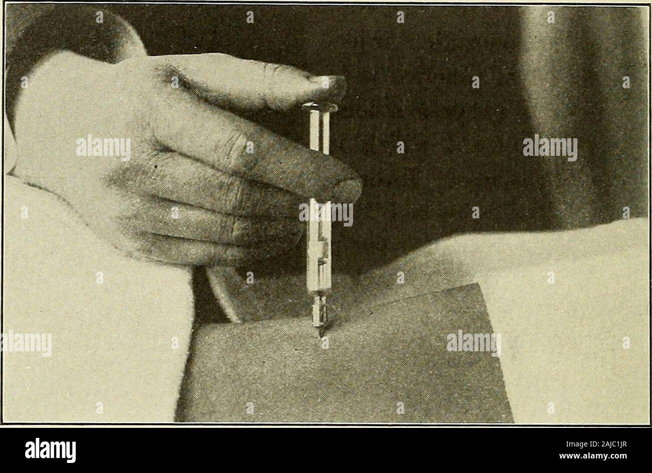 Vorbereitende und nach der Behandlung in der operativen Fällen. Abb. 196.-übliche Methode, durch die subkutane Injektionen. 236 Schock und sekundäre Blutung gencies erwähnt. Klein wie dieser Unterschied sein mag, es ist animportant Faktor bei wiederholten Injektionen sind in rascher vorgenommen werden. Abb. 197.- eine nützliche Methode, um eine subkutane Injektion. Folge. Eine Lektion in diesem Zusammenhang kann von morphinhabitues, der diese Methode verwenden und sind aber selten betrübt withabscess aufgelesen werden. Mechanischer DRUCK mechanischen Druck kann durch fest Bandagieren theextremities mit Geweben oder, noch besser, mit El Stockfoto