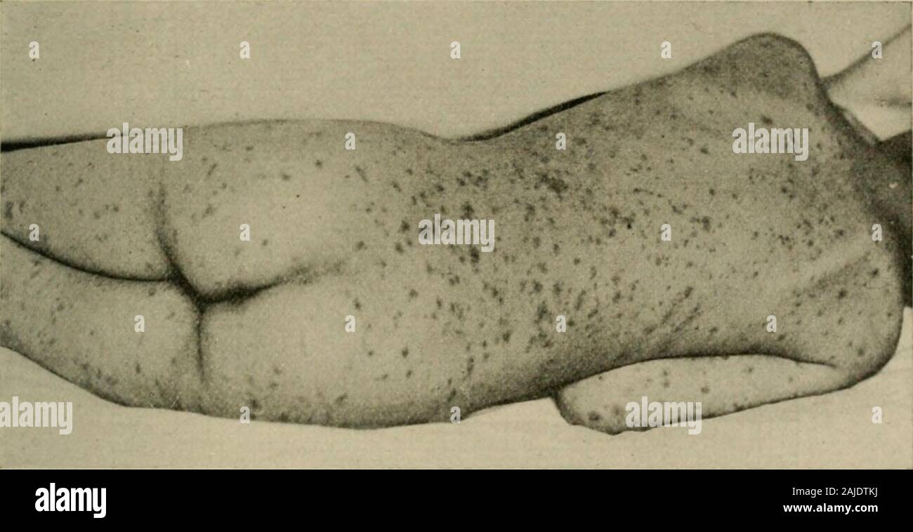 Die Krankheiten von Säuglingen und Kindern als charakteristisch für die Krankheit. Drynessdevelops, die in der Regel nur in den Fällen strenger sein, bei älteren Kindern. Typhus 395 den Zustand des Darms ist variabel. Verstopfung und diarrheaare etwa gleich häufig, der Ehemaligen vielleicht preponderating. Doch thisdepends auf die Epidemie, und es gab Jahre, in denen die Fälle nearlyall unter meiner Pflege Durchfall hatte, obwohl in der Regel nicht schwerwiegend. Die Stühle der typische pea-Suppe aussehen kann. Involuntaryevacuation erfolgt nur in Ausnahmefällen und in den schwersten Fällen. Der Bauch ist in der Regel nur Mo Stockfoto