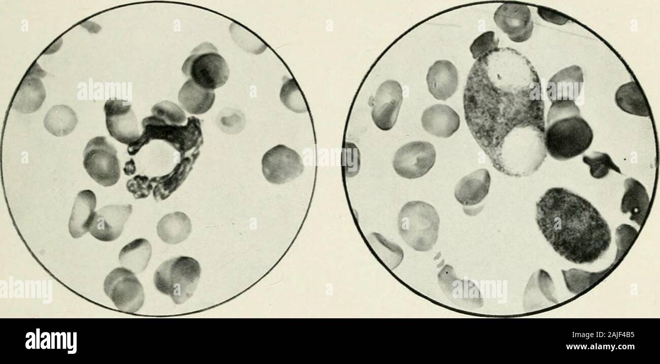 Medizinische und chirurgische Berichte., perniziöse Anämie die Zählung vorübergehend ansteigt, und dann fallsrapidly, die zu den vorherigen oder Unten. Die transfundierten Blut ist in diesen Fällen rapidlydestroyed. Die phagozytose im Blut - organsis zerstören in der Regel durch Makrophagen durchgeführt, aber in diesem Fall die polynuclearsmay haben an dem Prozess genommen und haben dann inden Verkehr gewaschen worden. Die phagozytose könnte auch durch die Präsenz von anopsonin für menschliche rote Blutkörperchen berücksichtigt werden. Savtchenko 9 gefunden, dass Dieanschlüsse an inaktiviertem Serum eines Kaninchens immun gegen Guinea-pig Cor-puscles, TOGE Stockfoto