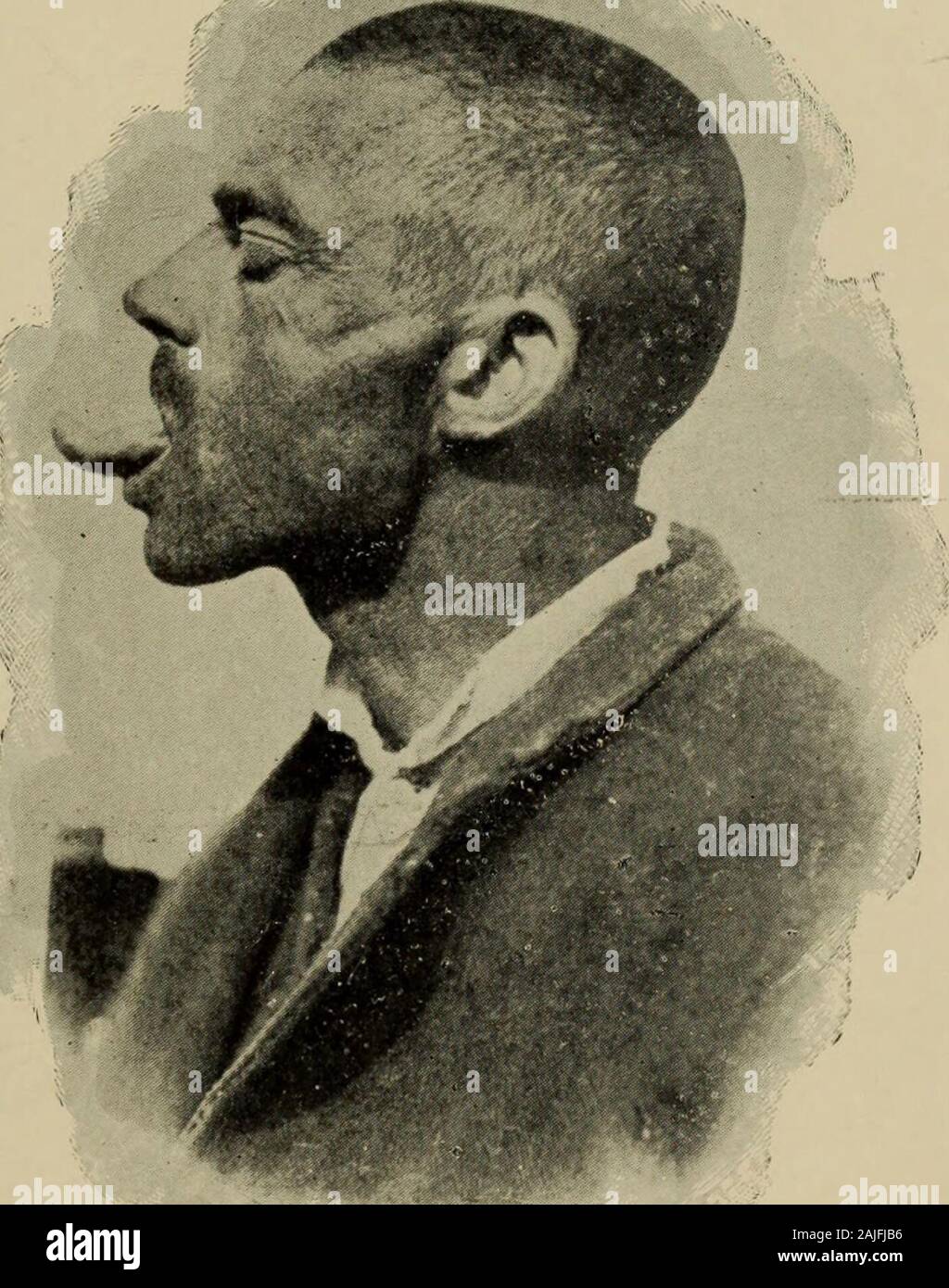 Ich problemi della degenerazione. Denti molari in soprannumero. (Talbot). 13. niacroglossia (Tav. V), e finalmente ogni possibileirregolarità nel Numero, nel Volumen, nella Sede, nella e giacitura Figura nella Direzione e Disposi-zione dei Denti, La mancanza di alcuni di Essi, il lorosoprappiù, che è un riacquisto filogenico di ciò chesi smarrì unser ontogenia (Abb. 13), la Loro posizionefuor di Luogo, nel palato (Abb. 14) o sul bordoalveolare, ich diastemi (intervalli lemurinici), leanedi-e retroversioni, la Carie precoce, Le, le scissure fusioni di svolgimento (Tav. VI), ed in ispecie, La fo Stockfoto