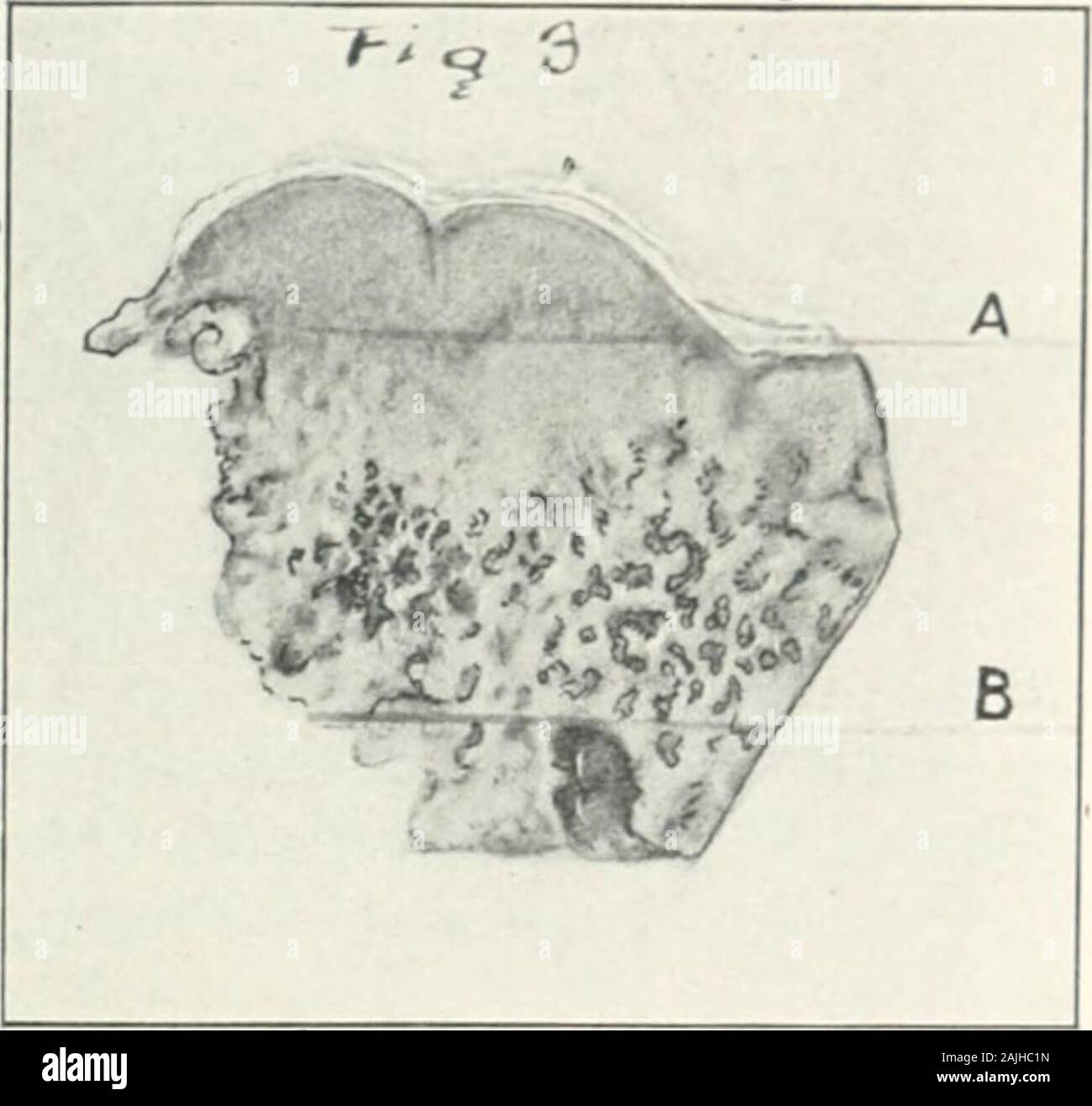 Transaktionen. Urface des Tumors mit fibrinand Eiter bedeckt: die oberflächlichen Gefäße zeigen zahlreiche purulentthrom]) Ich. Die Infektion kann durch direkte con verfolgt werden können - tinuity durch den Tumor, sondern, dass die Infektion undoul) t-nahm dieser Kurs Zweifel wird durch die infizierten Air Cells andmedulary Räume, die von der Website der Betrieb eine andreaching sliort disfaiK e der inneren Oberfläche des growtli zu witliiu gezeigt. Der Tumor besteht aus aktiv proliferierenden Kleine andlarge vess (Os, von denen die meisten thancapillaries sind etwas größer. In der Regel werden die Schiffe haben eine sehr konkrete Con-nective tiss Stockfoto