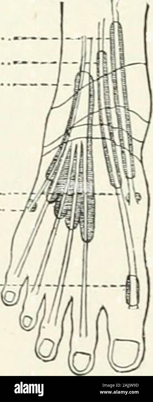 Eine Referenz Handbuch der medizinischen Wissenschaften, umfasst das gesamte Spektrum der wissenschaftlichen und praktischen Medizin und verwandter Wissenschaften. stant. Externe morefrequent. Vagin (B tendinum m. extensoris digitorum Pedis longi; Vag. tendinis m. extensoris hallucis longi; Vag. tendinis m. tibialis anterioris (Abb. 1178). Um die Sehnen der Muskeln. Nicht quenth infre - Der Mantel der Streckmuskeln erweitert somewhathigher bis als in der Abbildung dargestellt ist. B. sinus tarsi (Gruber). Zwischen der Faszie whichbinds der extensor digitorum Longus und thehead Der astragal. Sehr häufig (5 in 12, Synnestved Stockfoto